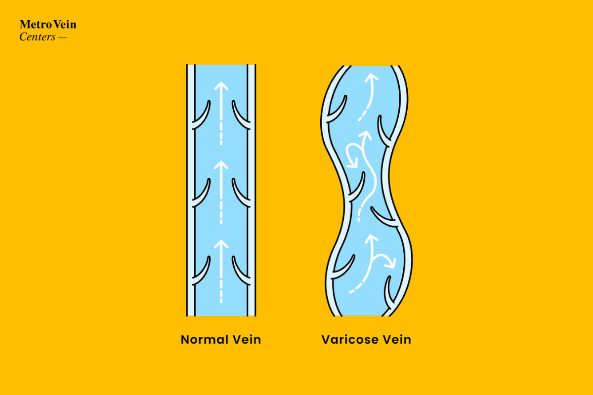 The 9 best ways to treat varicose veins