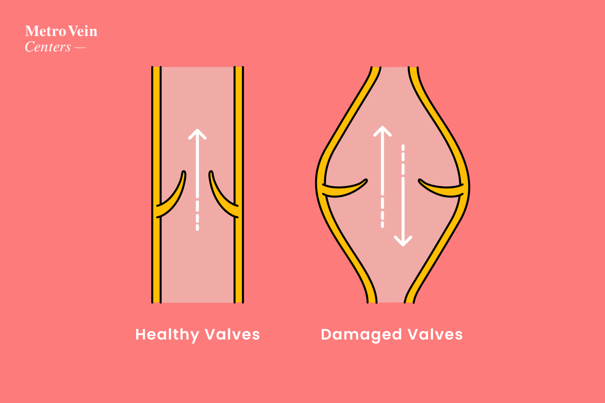 Chronic Venous Insufficiency: 5 Most Common Causes  Vein Center in Walnut  Creek, Brentwood, and Oakland