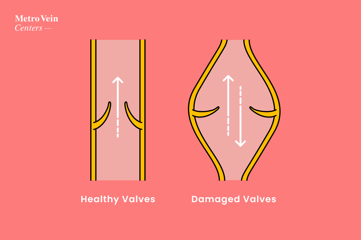 8 Risk Factors for Venous Insufficiency