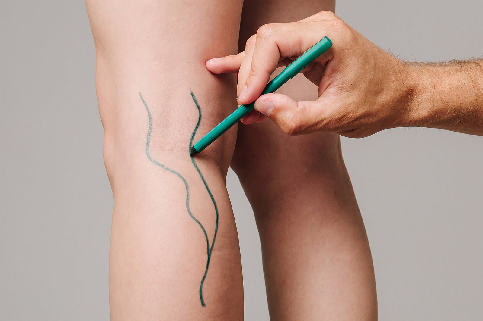Explore the intricate leg vein circulatory system, its function, and how to maintain healthy veins. Learn about vein types, blood flow, and prevention tips.