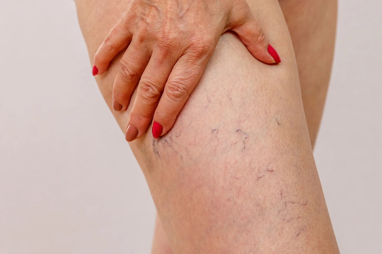 Discover why veins burst, the warning signs, and treatment options. Learn how to prevent complications and protect your vascular health.