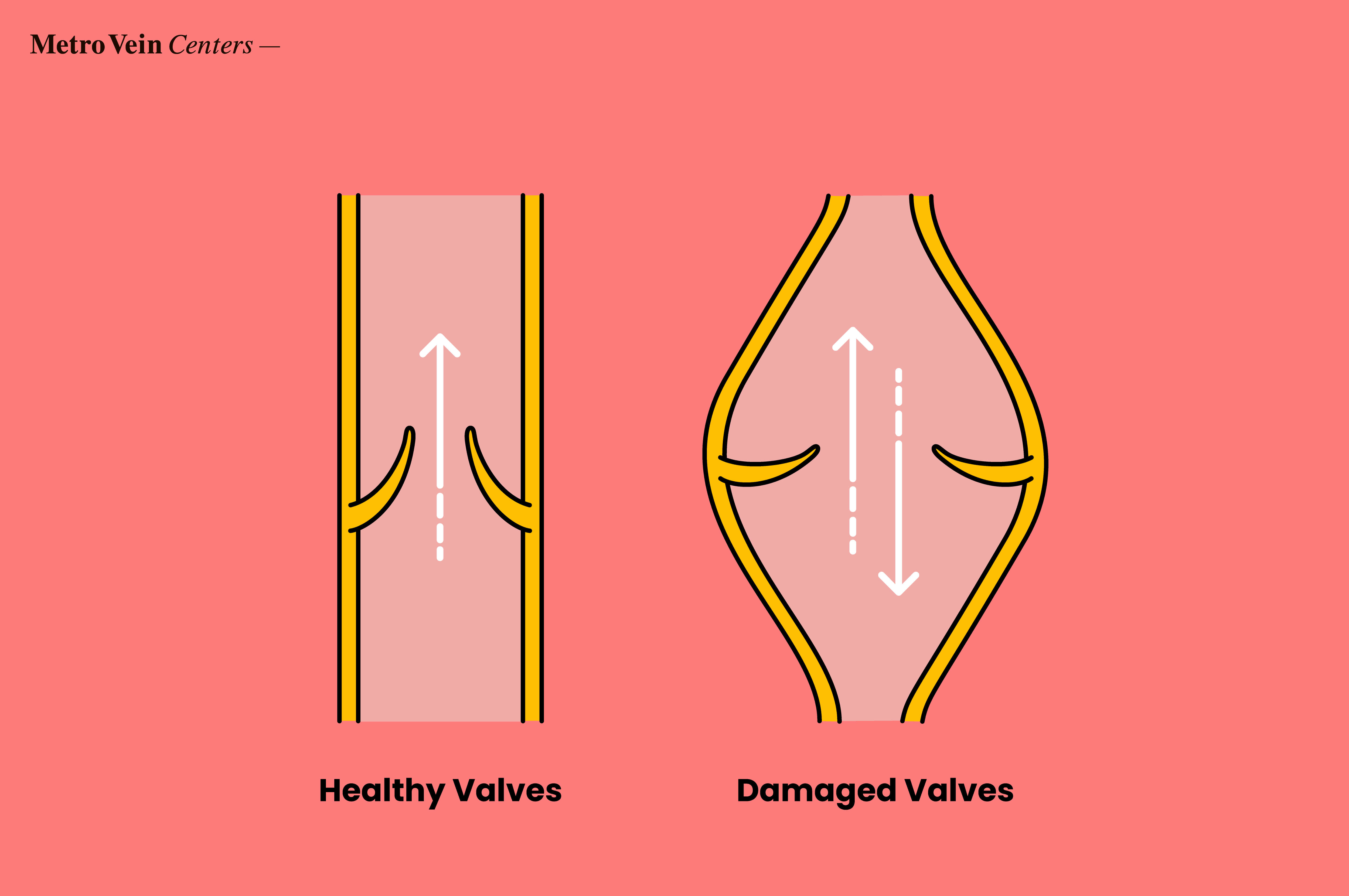 blood flow in healthy veins vs damaged veins with venous insufficiency