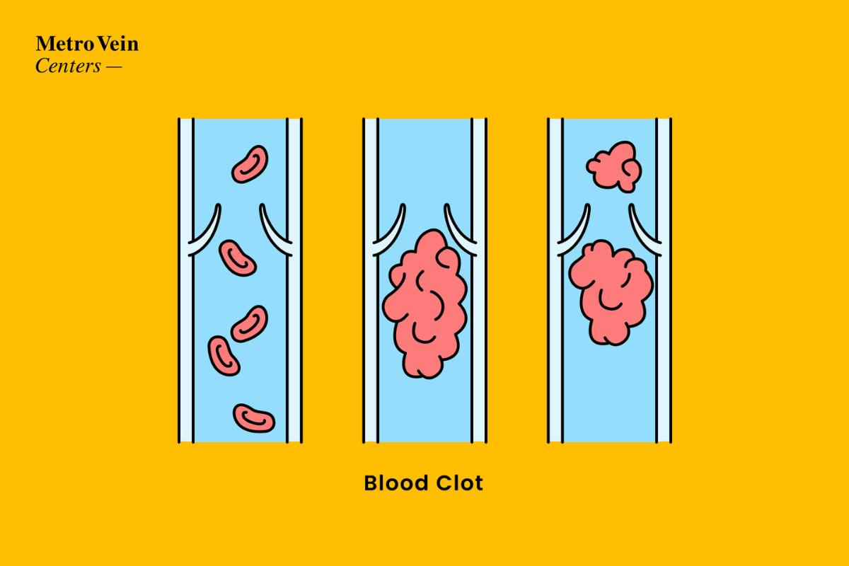 What Are The Symptoms of DVT? | Metro Vein Centers