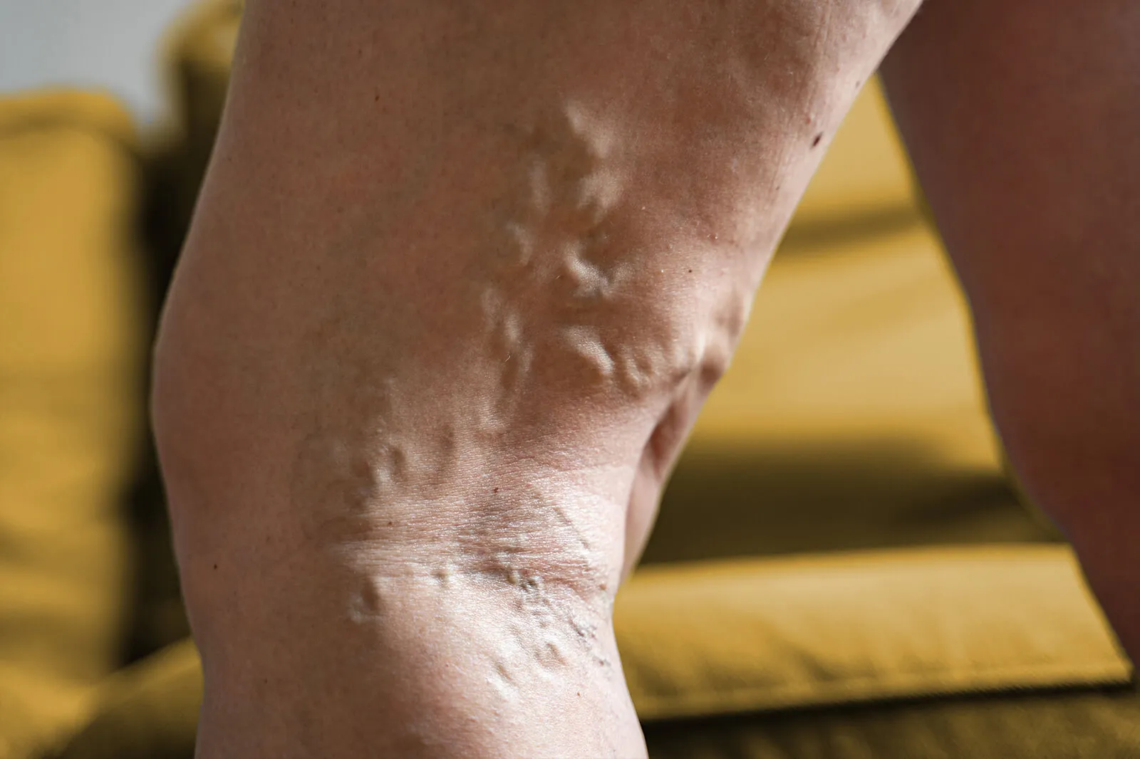 Delve into how genetic predispositions contribute to venous diseases like varicose veins and deep vein thrombosis, and understand the implications for diagnosis and treatment.​