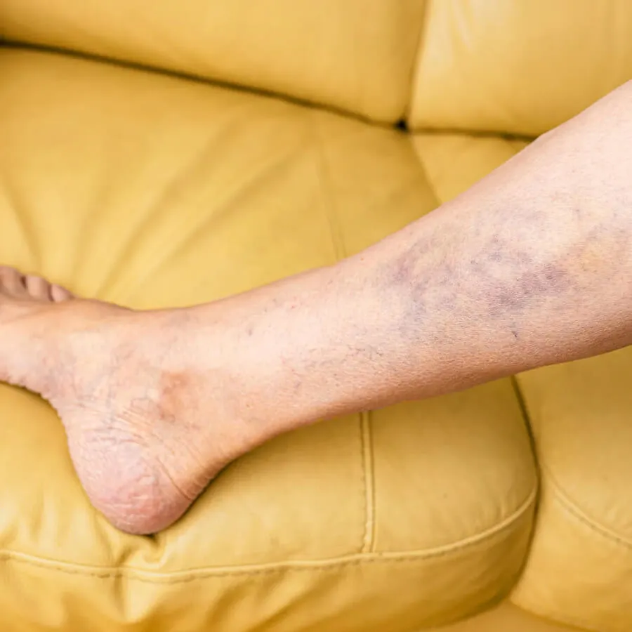 Learn about hemosiderin staining, its causes like chronic venous insufficiency, symptoms, and effective treatments such as laser therapy, compression therapy, and lifestyle changes to improve vein health and skin discoloration.