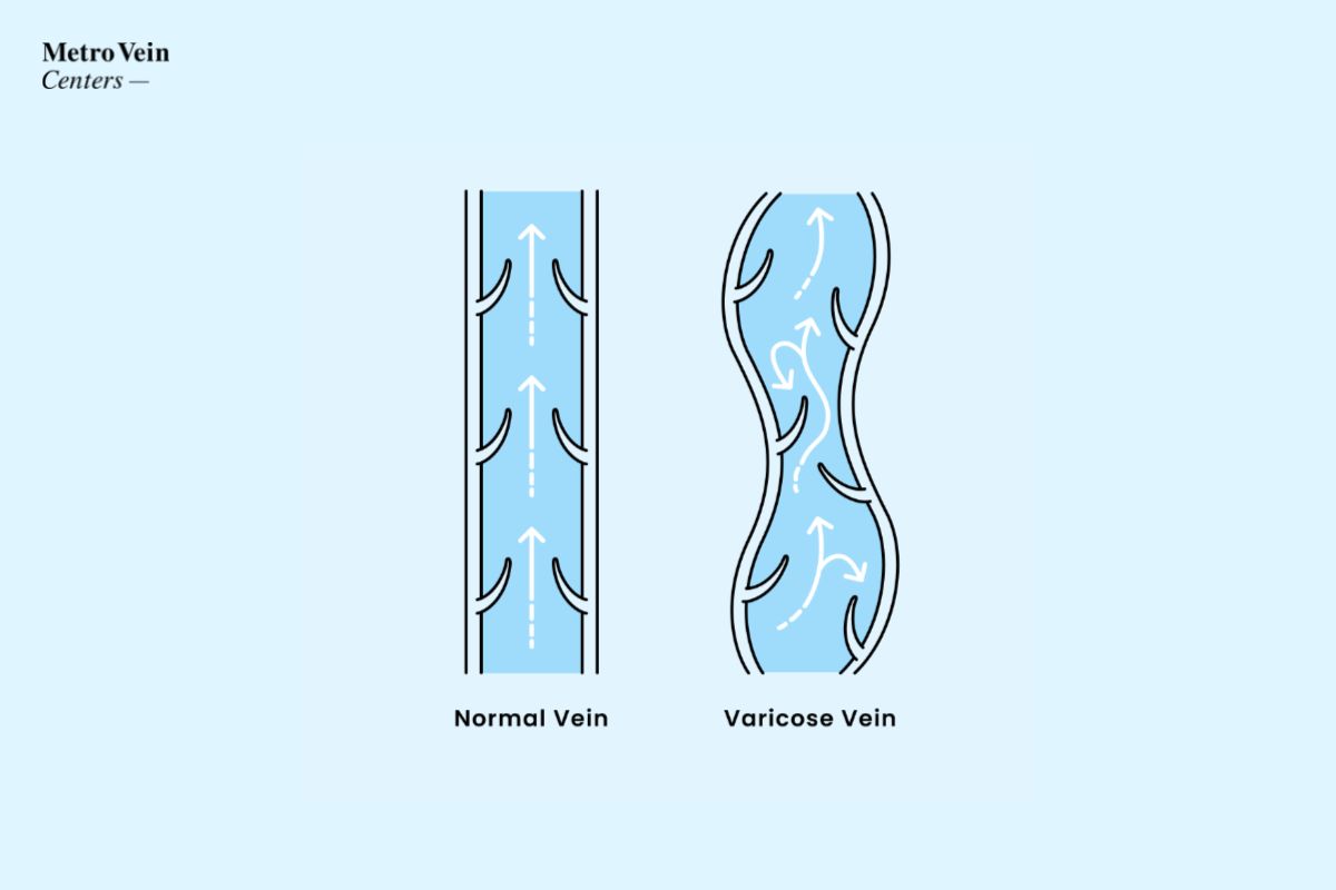 How To Prevent Varicose Veins