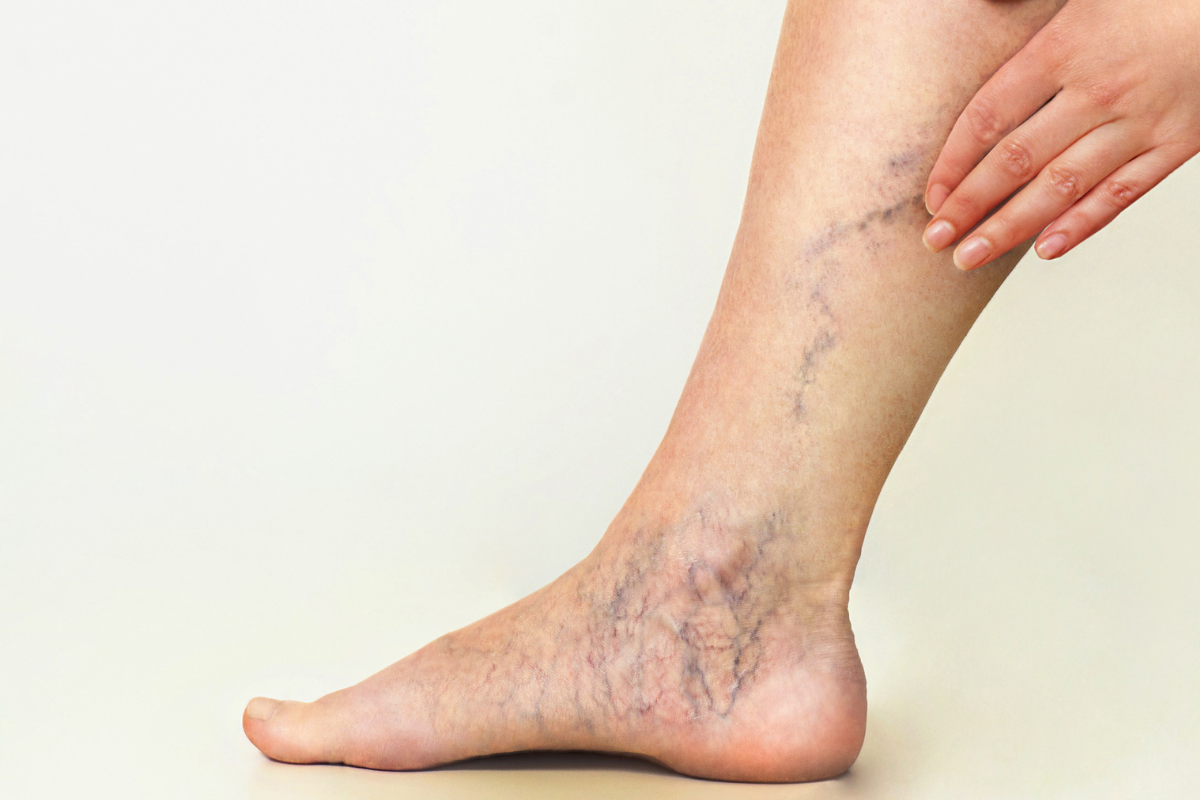 How to Treat Foot and Ankle Spider Veins