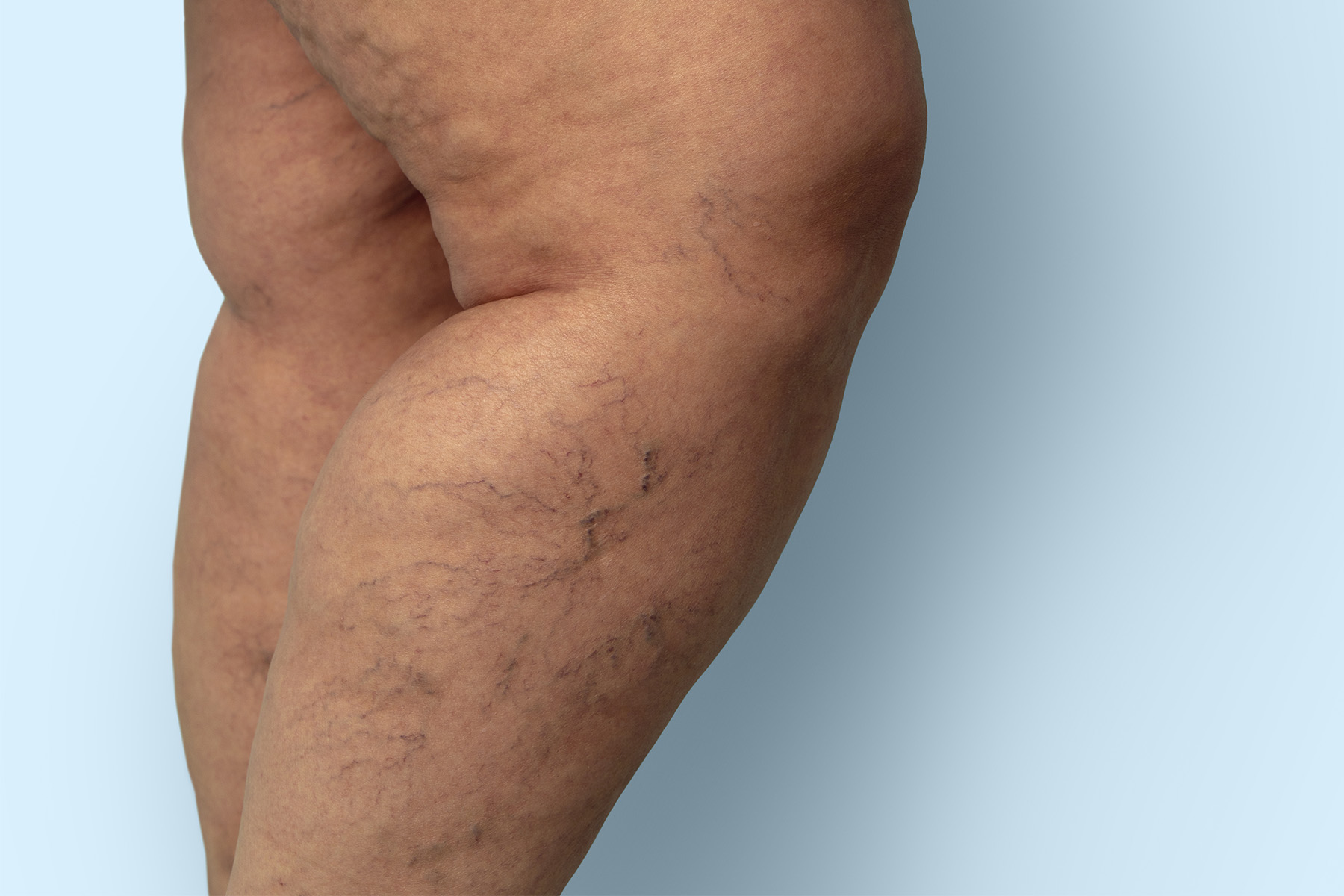 Explore how lymphedema and varicose veins are connected, what makes them different, shared risk factors, and when to seek expert vein specialist care.