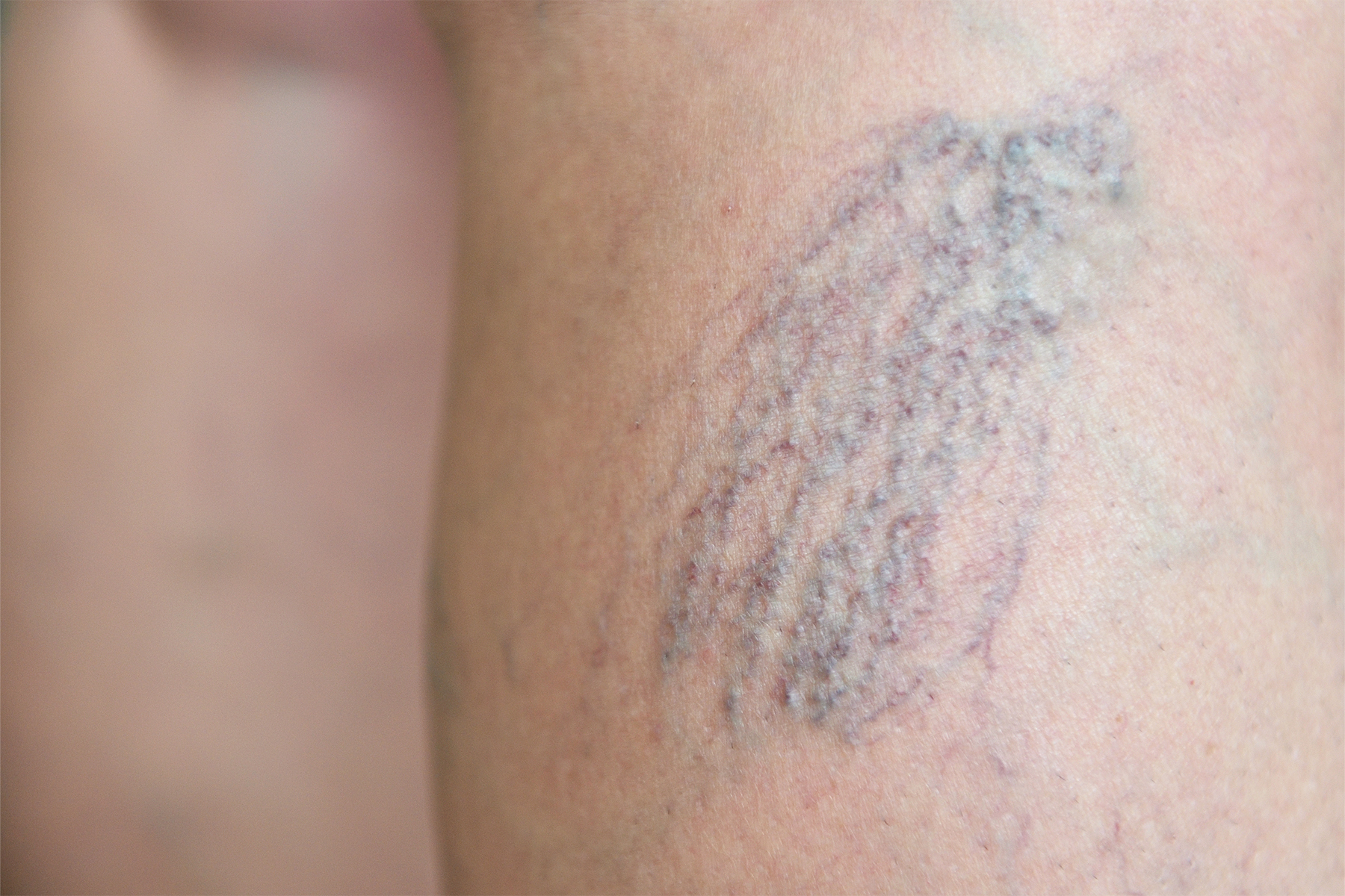 Discover expert tips for maintaining healthy leg veins, preventing varicose veins, and treatment options specifically designed for women's vascular health needs.