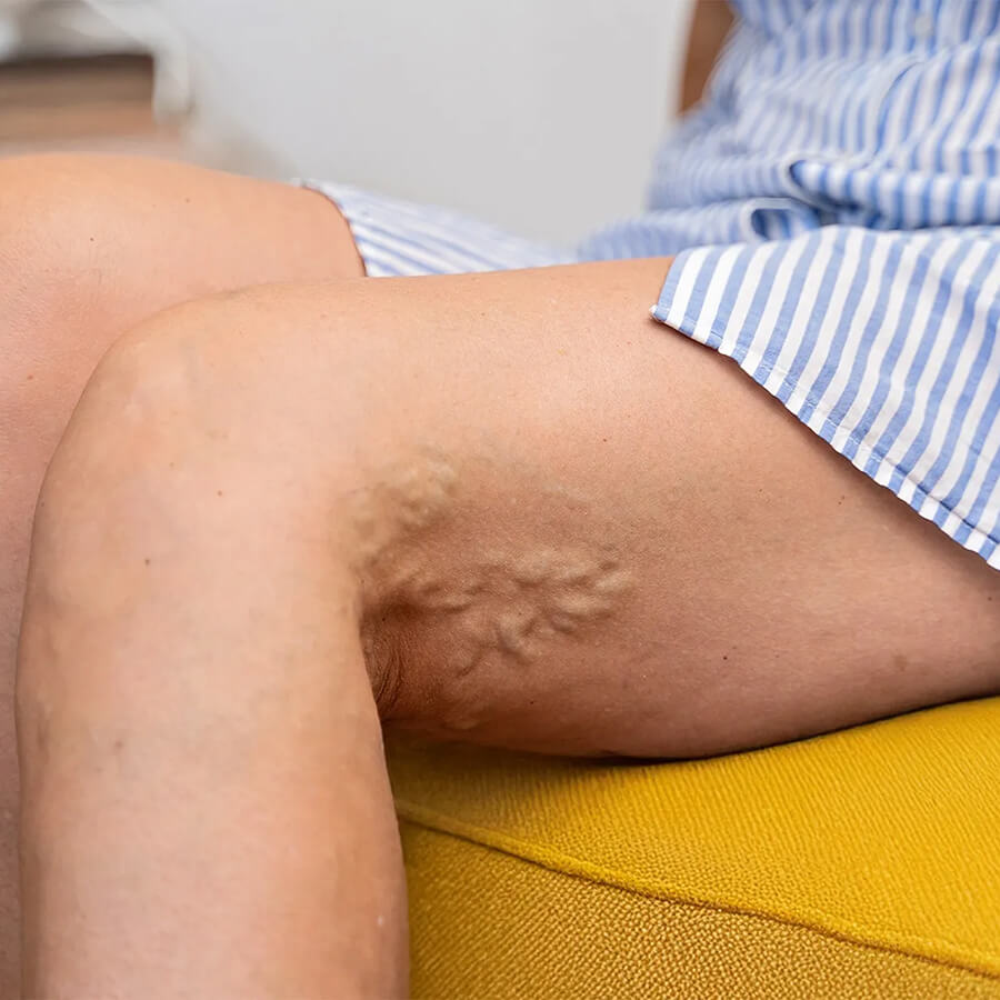 Learn about the physical, emotional, and social effects varicose veins have on daily life. Discover practical strategies to manage symptoms and improve quality of life.