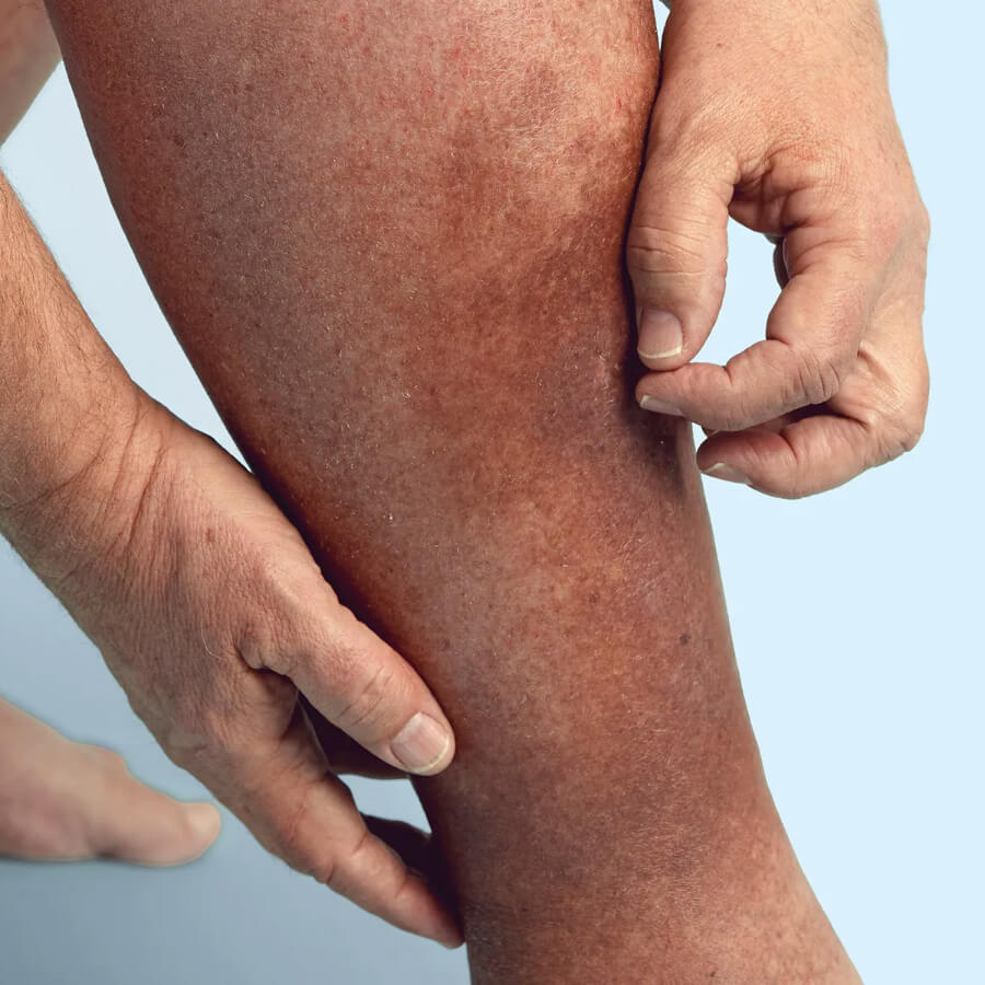President Trump&rsquo;s chronic venous insufficiency (CVI) diagnosis explained: symptoms, causes, and modern treatments for this common, treatable vein disease.