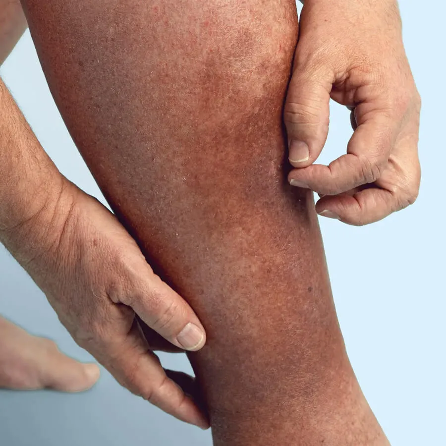 President Trump’s chronic venous insufficiency (CVI) diagnosis explained: symptoms, causes, and modern treatments for this common, treatable vein disease.