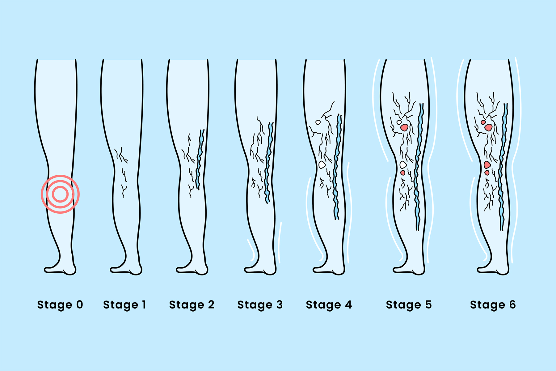 President Trump’s chronic venous insufficiency (CVI) diagnosis explained: symptoms, causes, and modern treatments for this common, treatable vein disease.