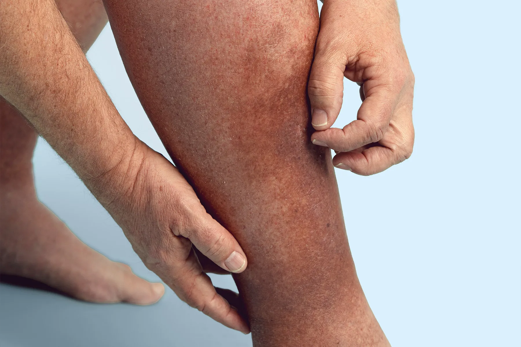 President Trump’s chronic venous insufficiency (CVI) diagnosis explained: symptoms, causes, and modern treatments for this common, treatable vein disease.