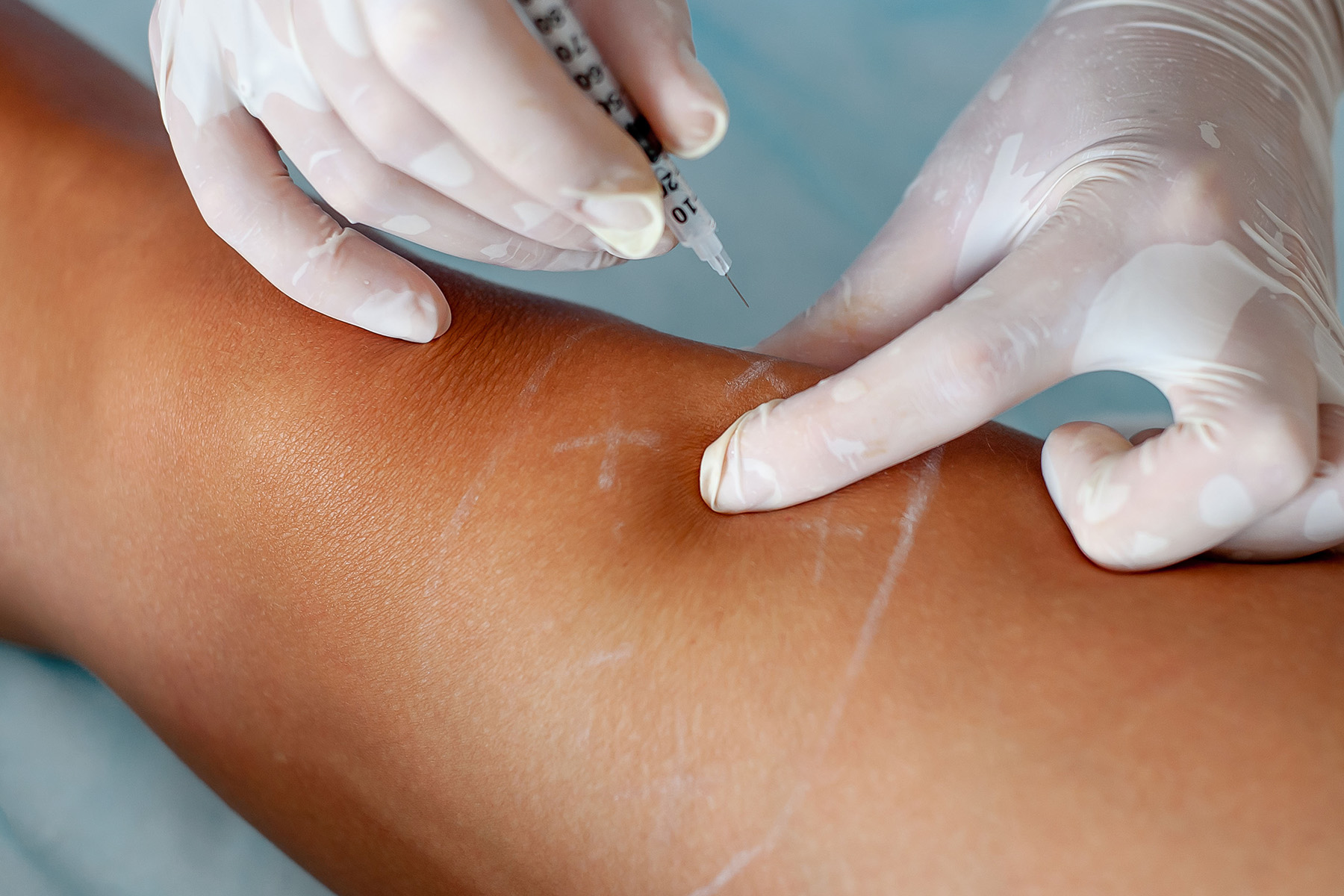 Worried about recovery after vein treatment? Don't be! Metro Vein Centers' minimally invasive procedures offer quick recovery, often with little to no downtime. Learn how to speed up healing and get back to your routine fast.
