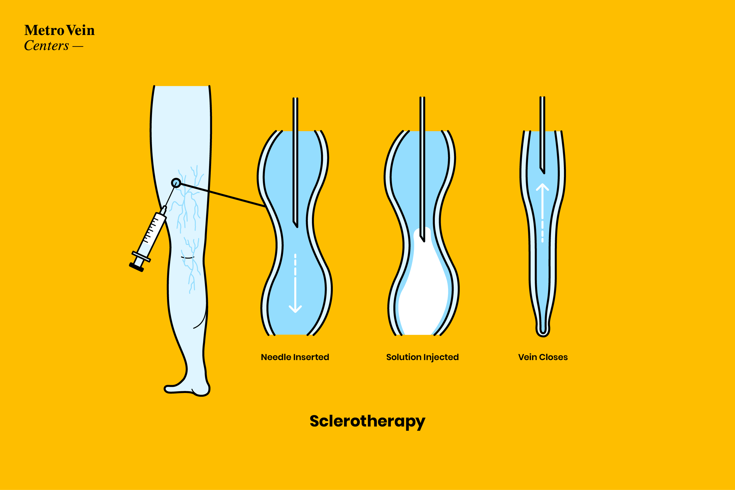 sclerotherapy