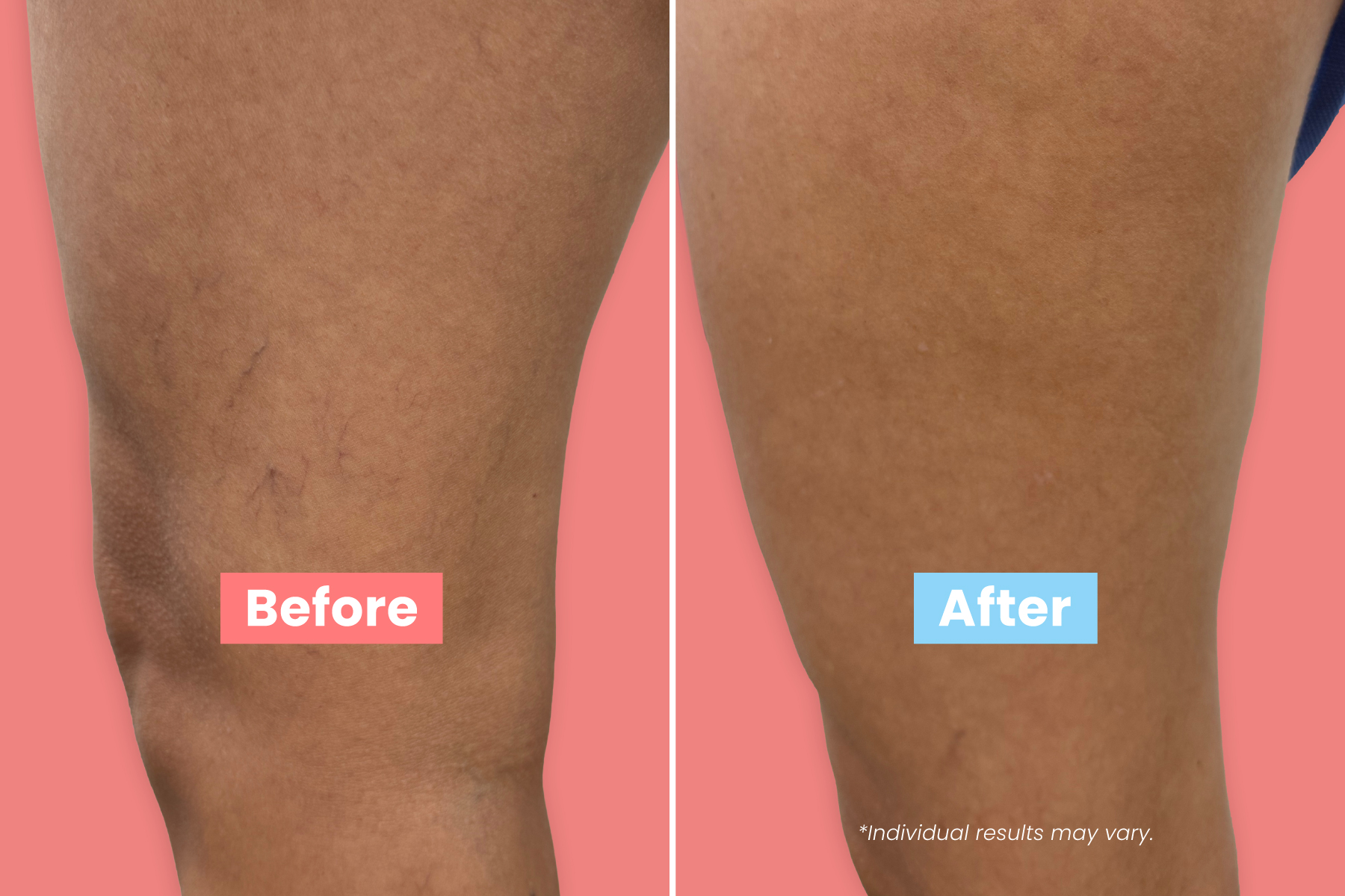 Show your legs some love with simple vein care tips that boost comfort, circulation, and confidence. Healthy legs feel better.