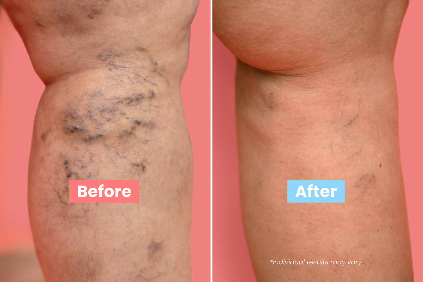 Show your legs some love with simple vein care tips that boost comfort, circulation, and confidence. Healthy legs feel better.