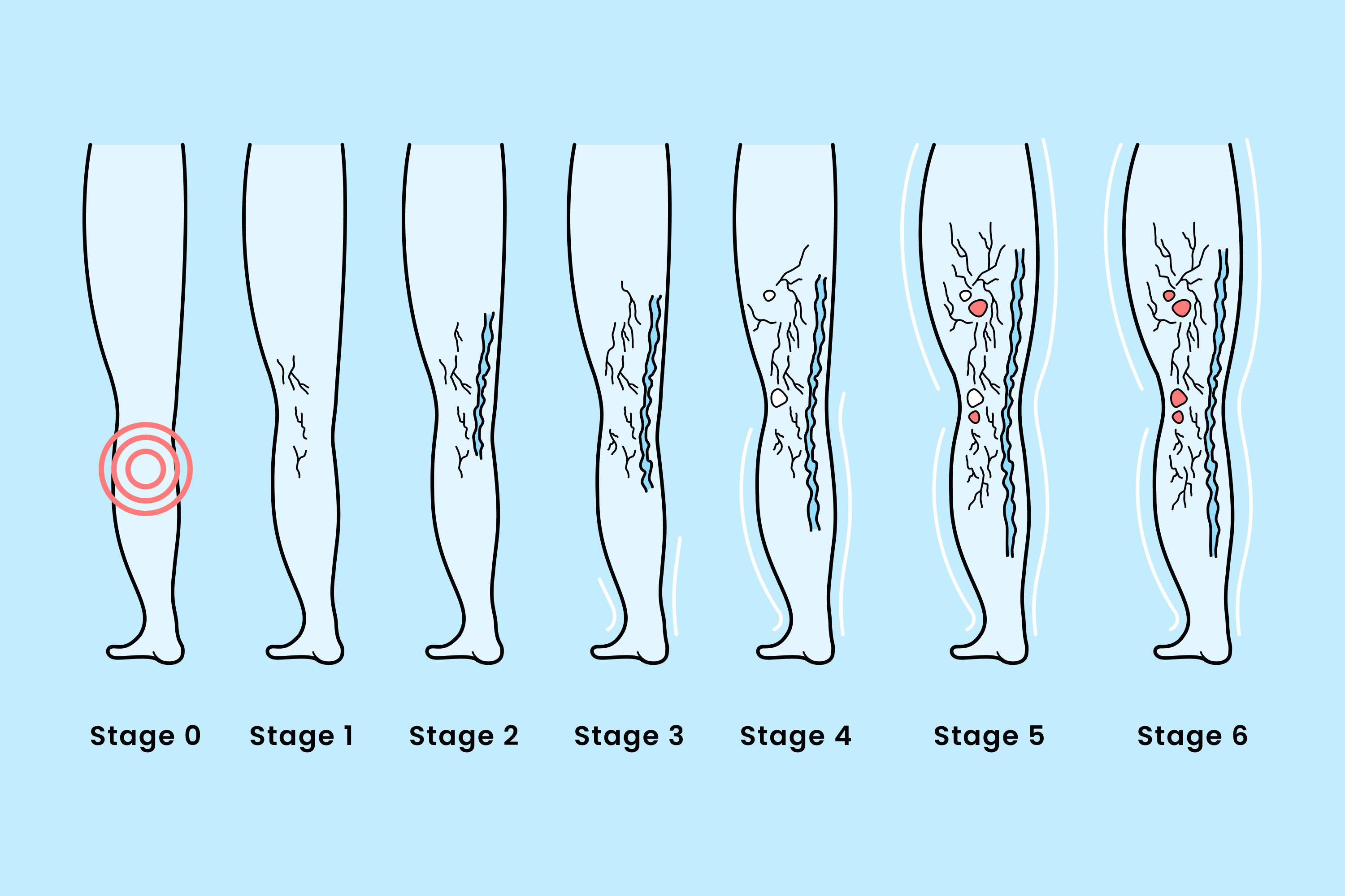 Learn about the clinical stages of varicose veins from early spider veins to advanced venous ulcers, plus treatment options for each stage and prevention strategies for healthier legs.