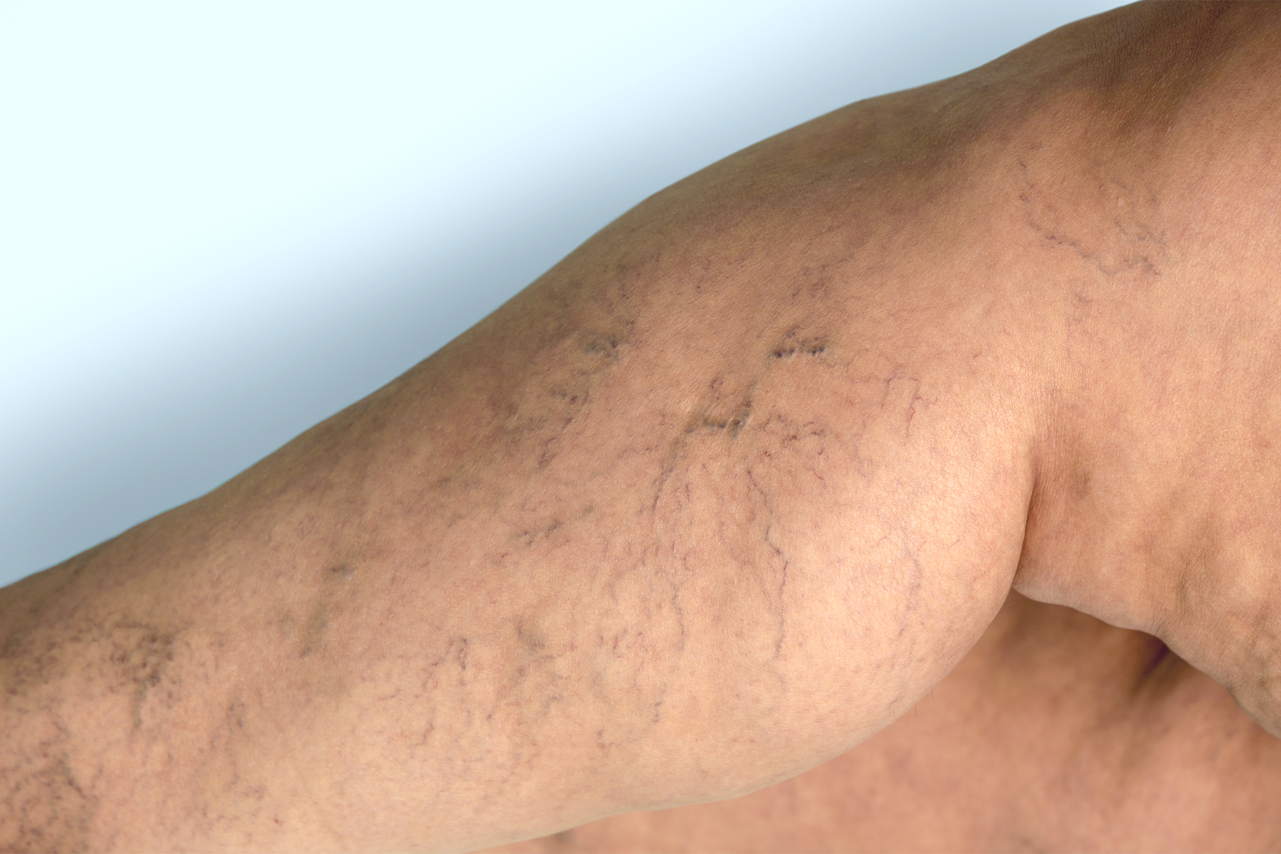 Learn about the clinical stages of varicose veins from early spider veins to advanced venous ulcers, plus treatment options for each stage and prevention strategies for healthier legs.