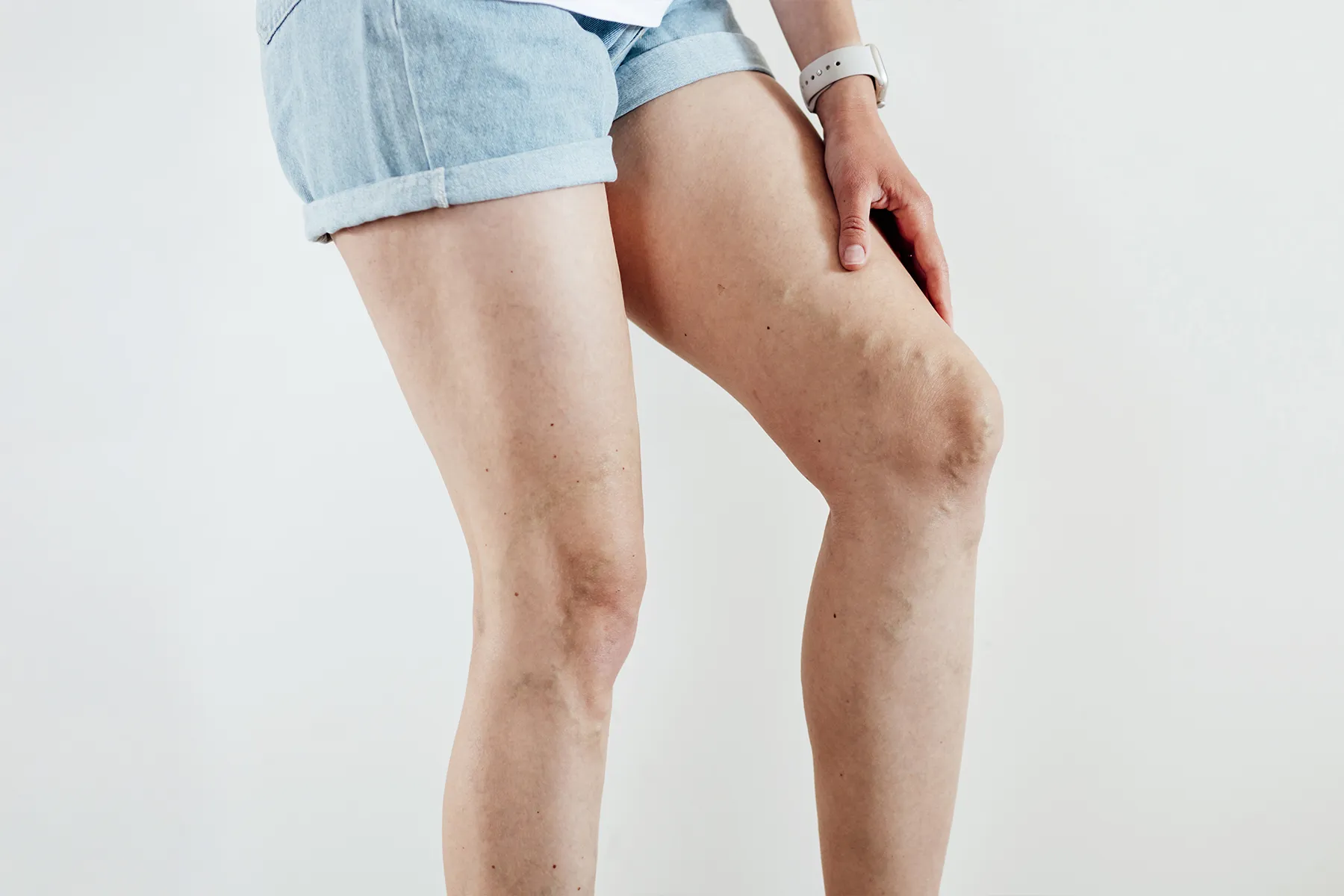 Learn about the clinical stages of varicose veins from early spider veins to advanced venous ulcers, plus treatment options for each stage and prevention strategies for healthier legs.