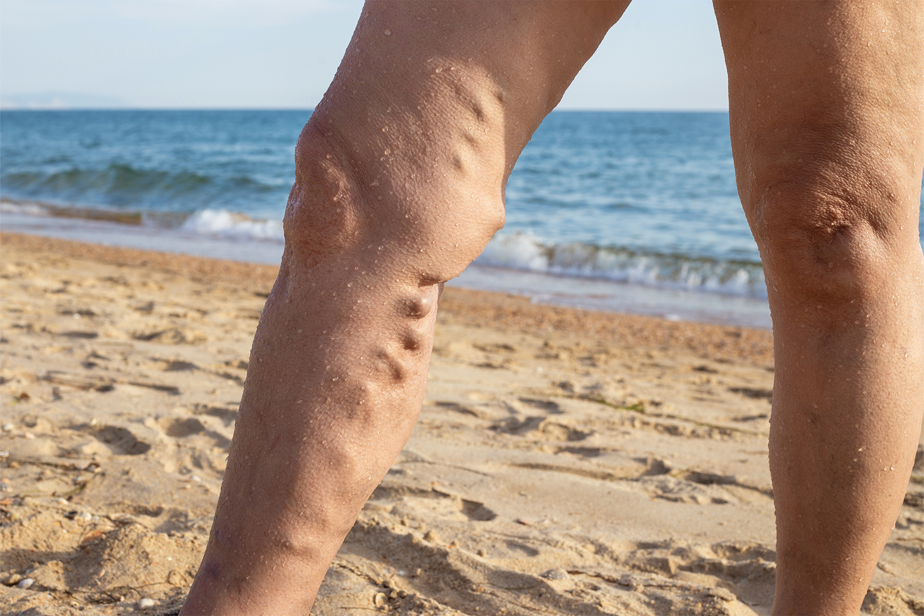 Discover the surprising link between sun exposure and spider veins and learn how you can protect your leg veins from sun and heat.