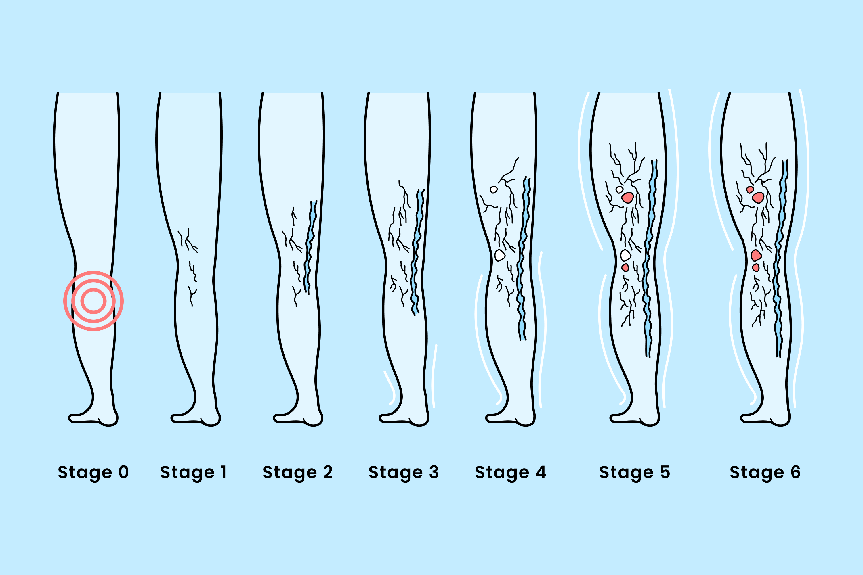 Behind the veil of everyday health concerns lies a silent threat that often goes unnoticed until it reaches its advanced stages: chronic venous insufficiency (CVI), also known as vein disease.