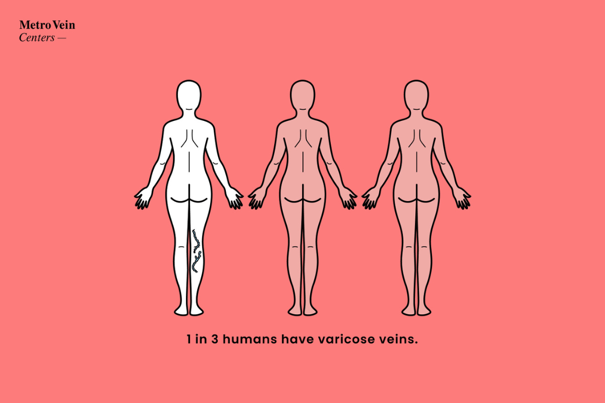 Behind the veil of everyday health concerns lies a silent threat that often goes unnoticed until it reaches its advanced stages: chronic venous insufficiency (CVI), also known as vein disease.