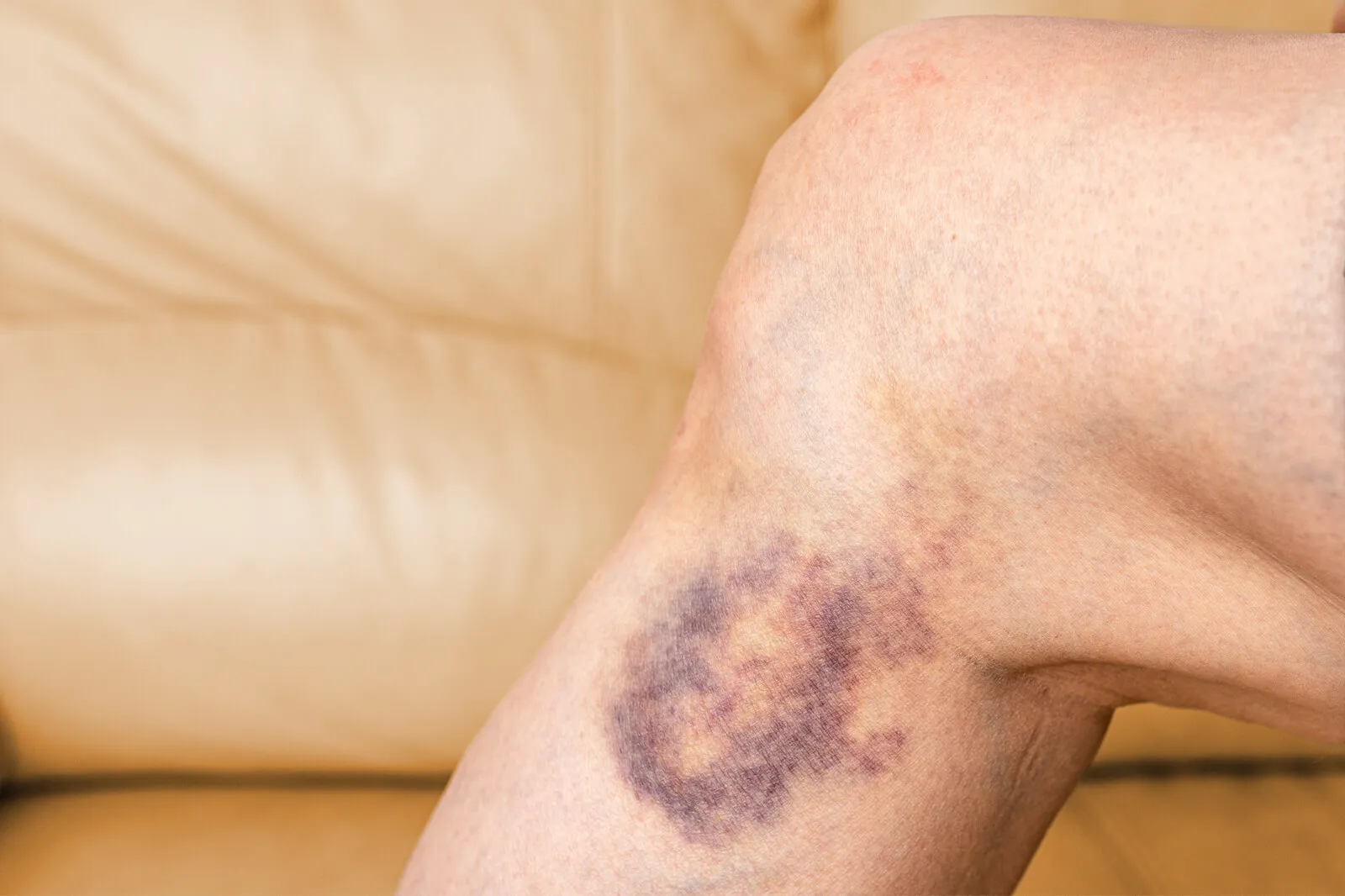 Discover what causes varicose vein bruising, how to prevent it, and the treatment options available for healthier, less bruised legs.