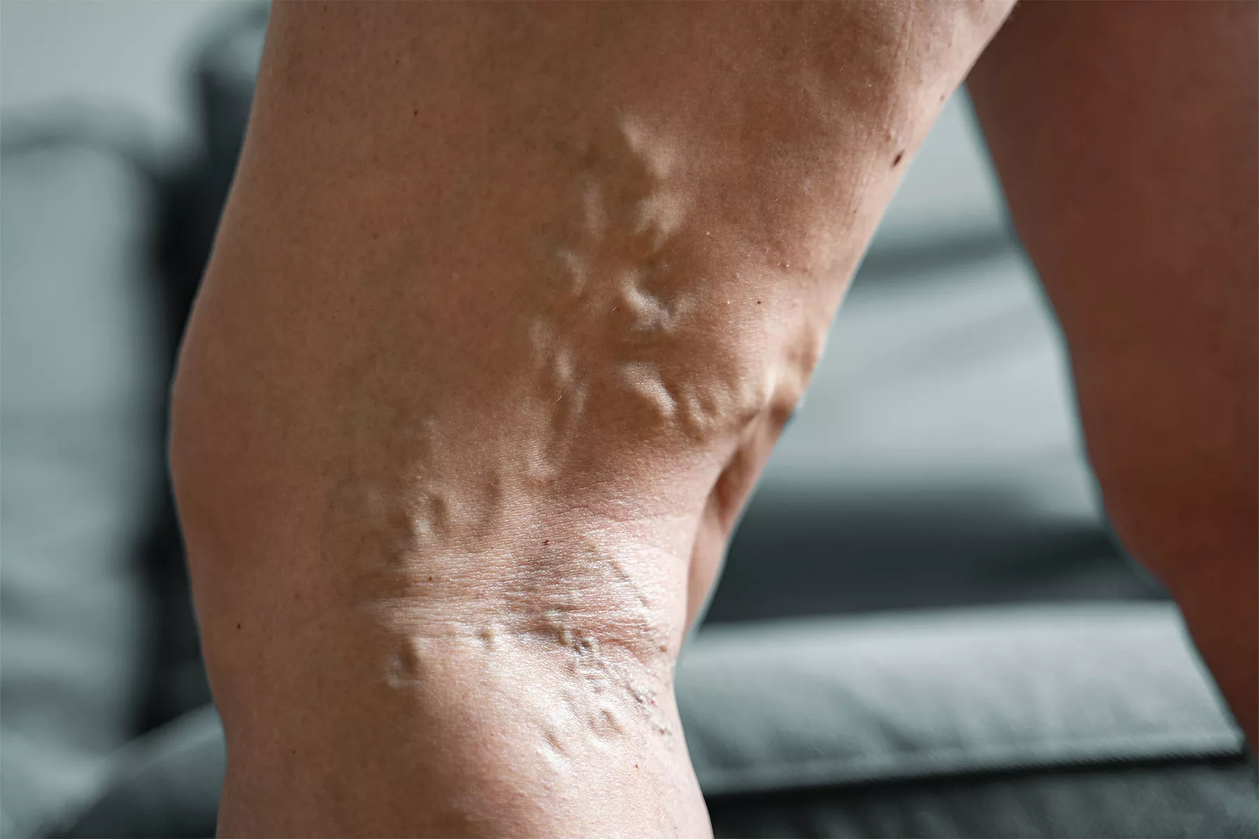 Explore venous reflux disease, its causes, symptoms, and treatment options. Learn how to manage this condition for healthier, pain-free legs.