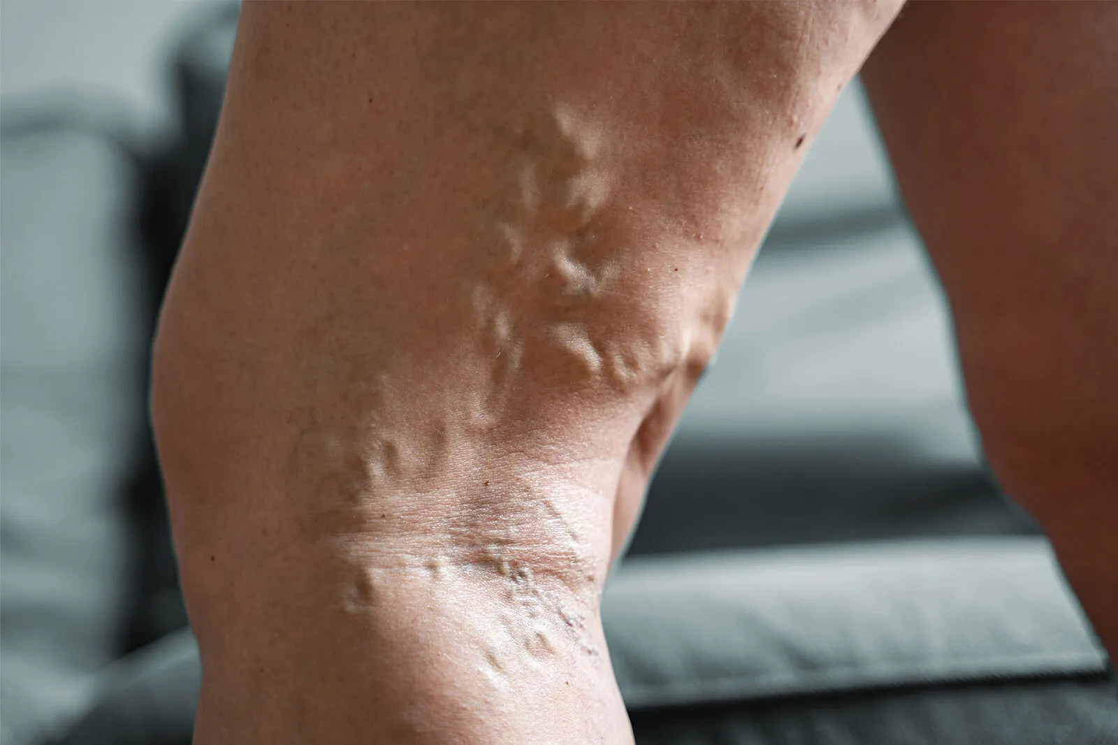 Explore venous reflux disease, its causes, symptoms, and treatment options. Learn how to manage this condition for healthier, pain-free legs.