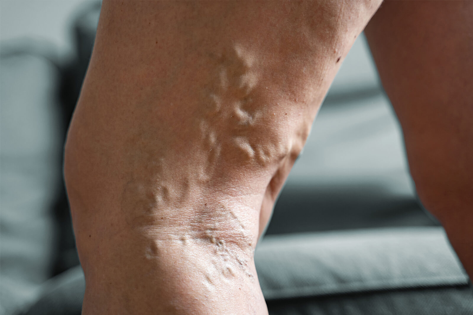 Explore venous reflux disease, its causes, symptoms, and treatment options. Learn how to manage this condition for healthier, pain-free legs.