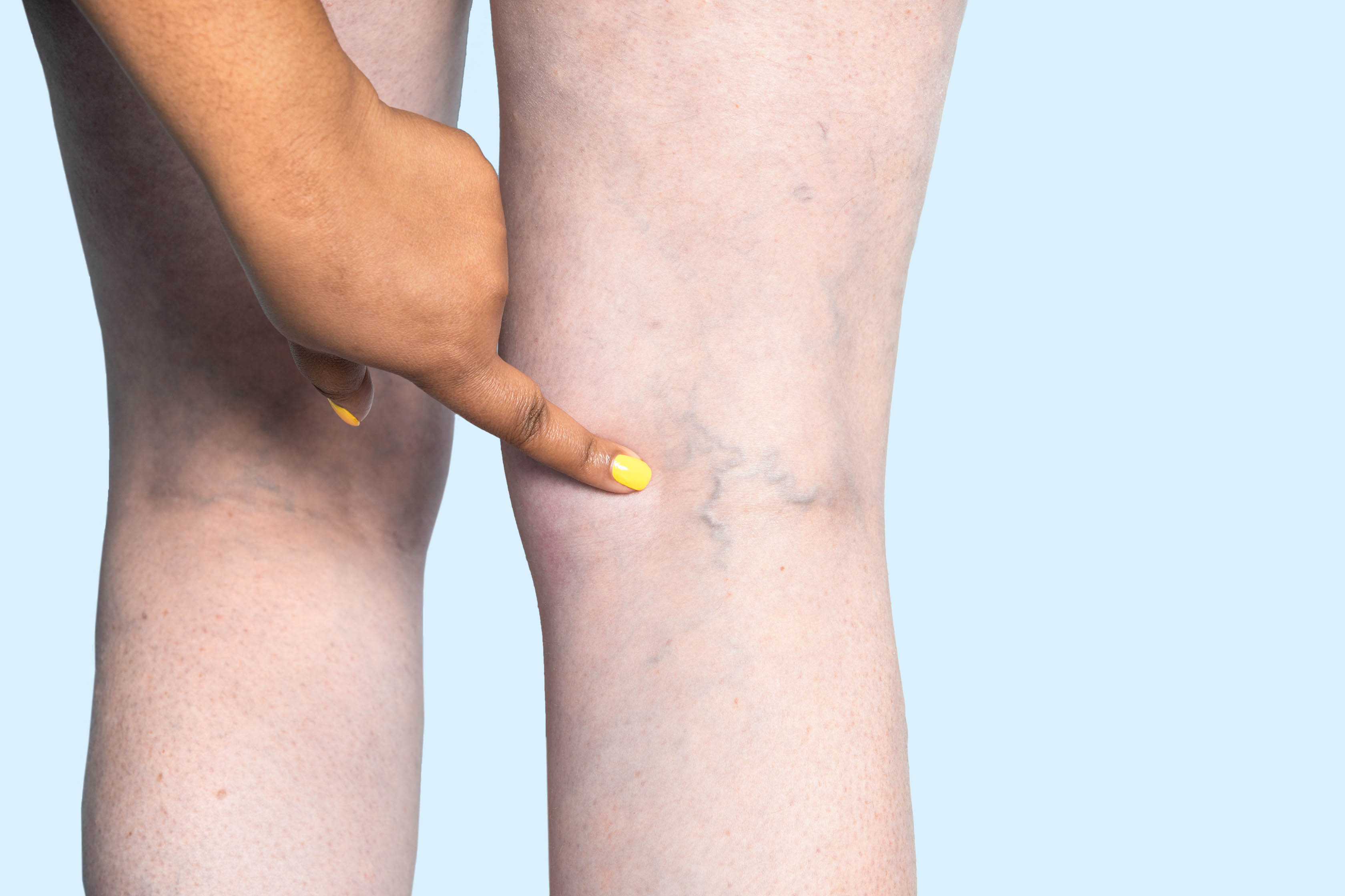 A Closer Look at Chronic Venous Insufficiency: Understanding