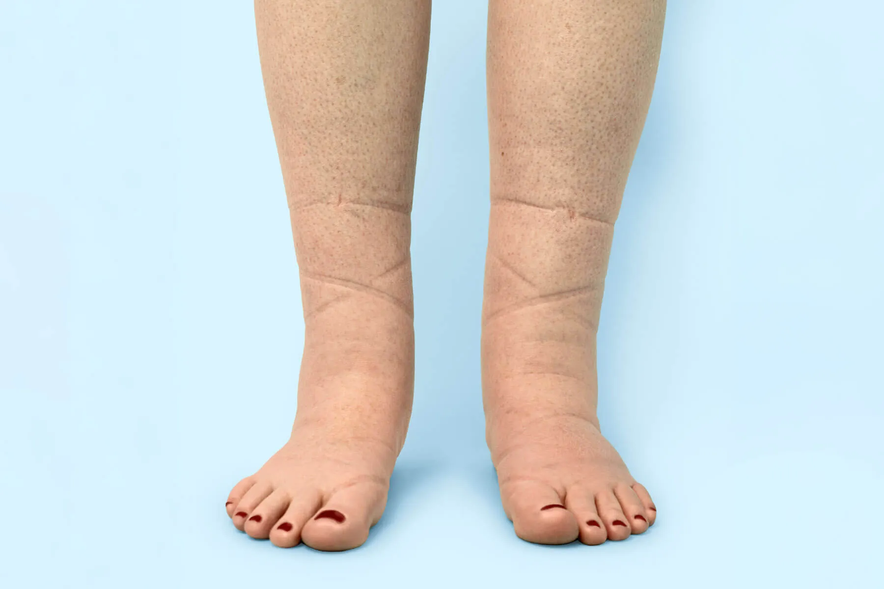 edema