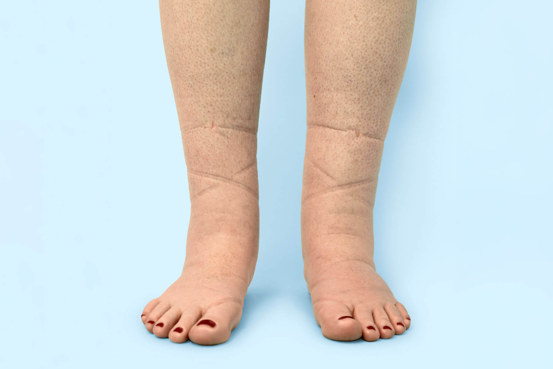 edema