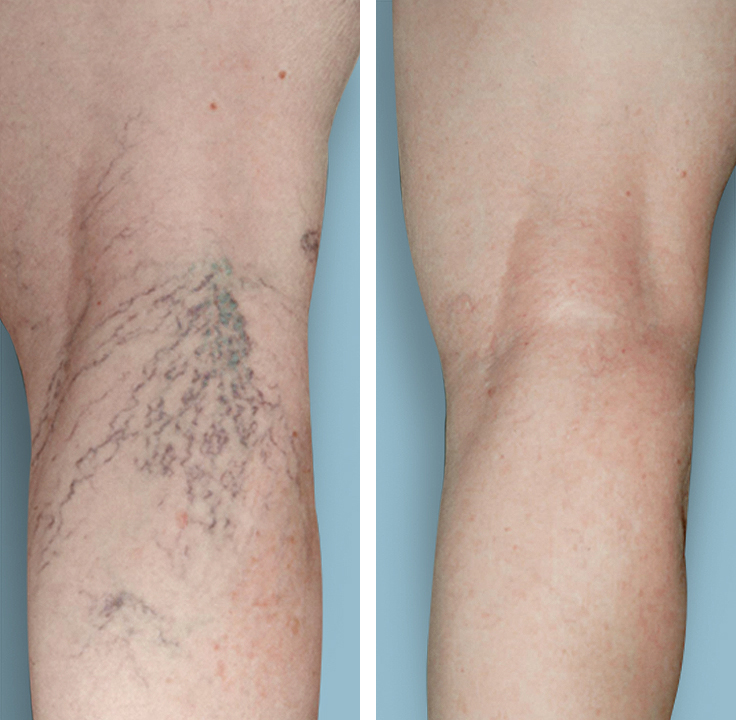 Before and after images of sclerotherapy vein treatments