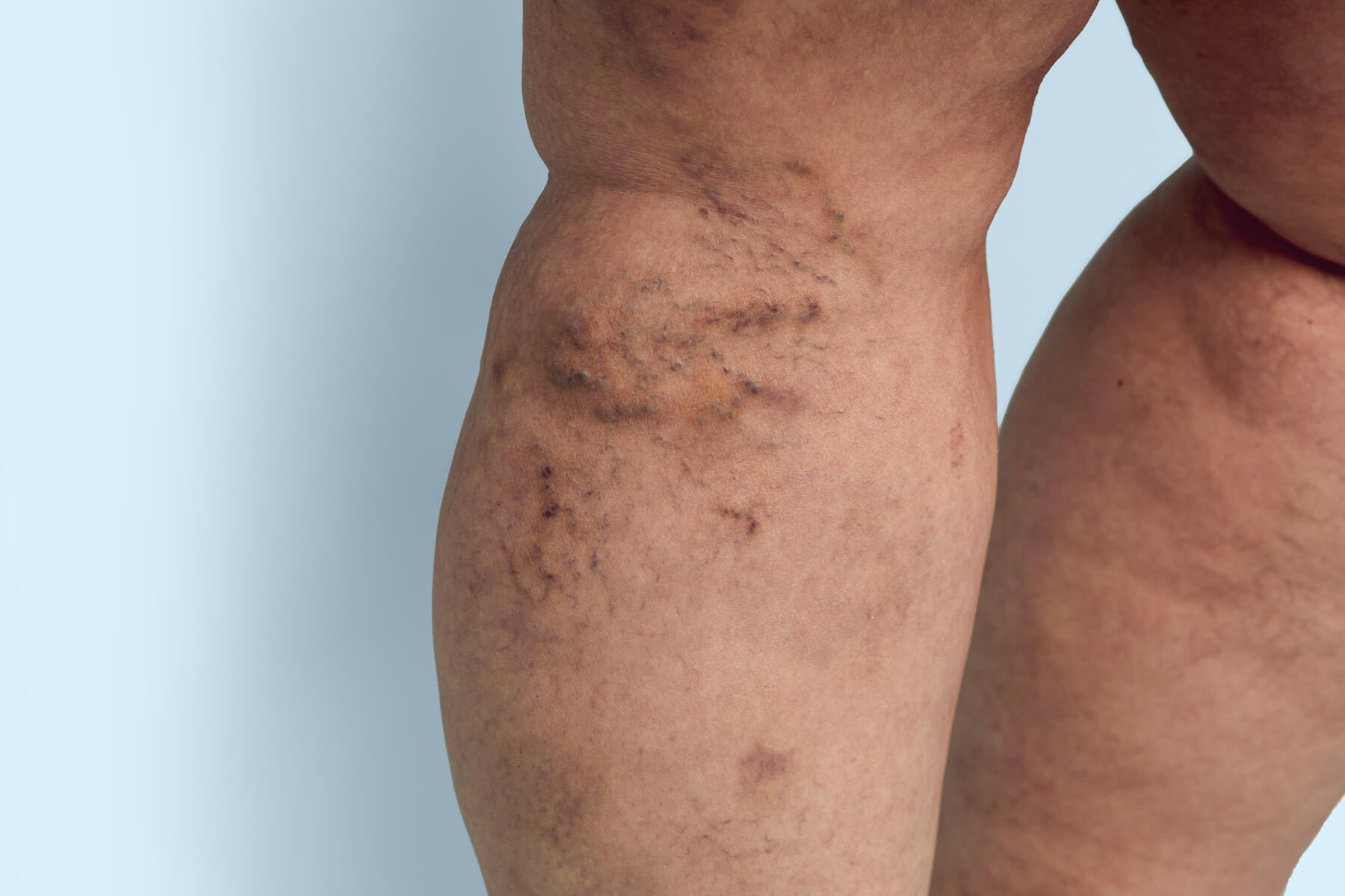 legs with spider veins