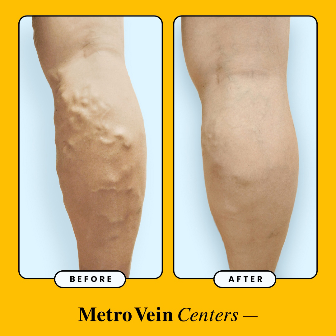 Ready for healthier legs? Learn why fall is the ideal time for vein treatment, offering a comfortable recovery and maximized insurance benefits