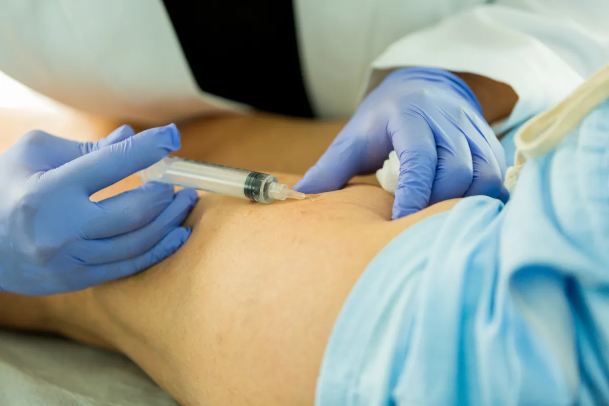 ¿Es la escleroterapia adecuada para tus venas? Descubre 4 cosas esenciales: duración, efectos secundarios, recuperación y resultados reales. ¡Infórmate en Metro Vein Centers!