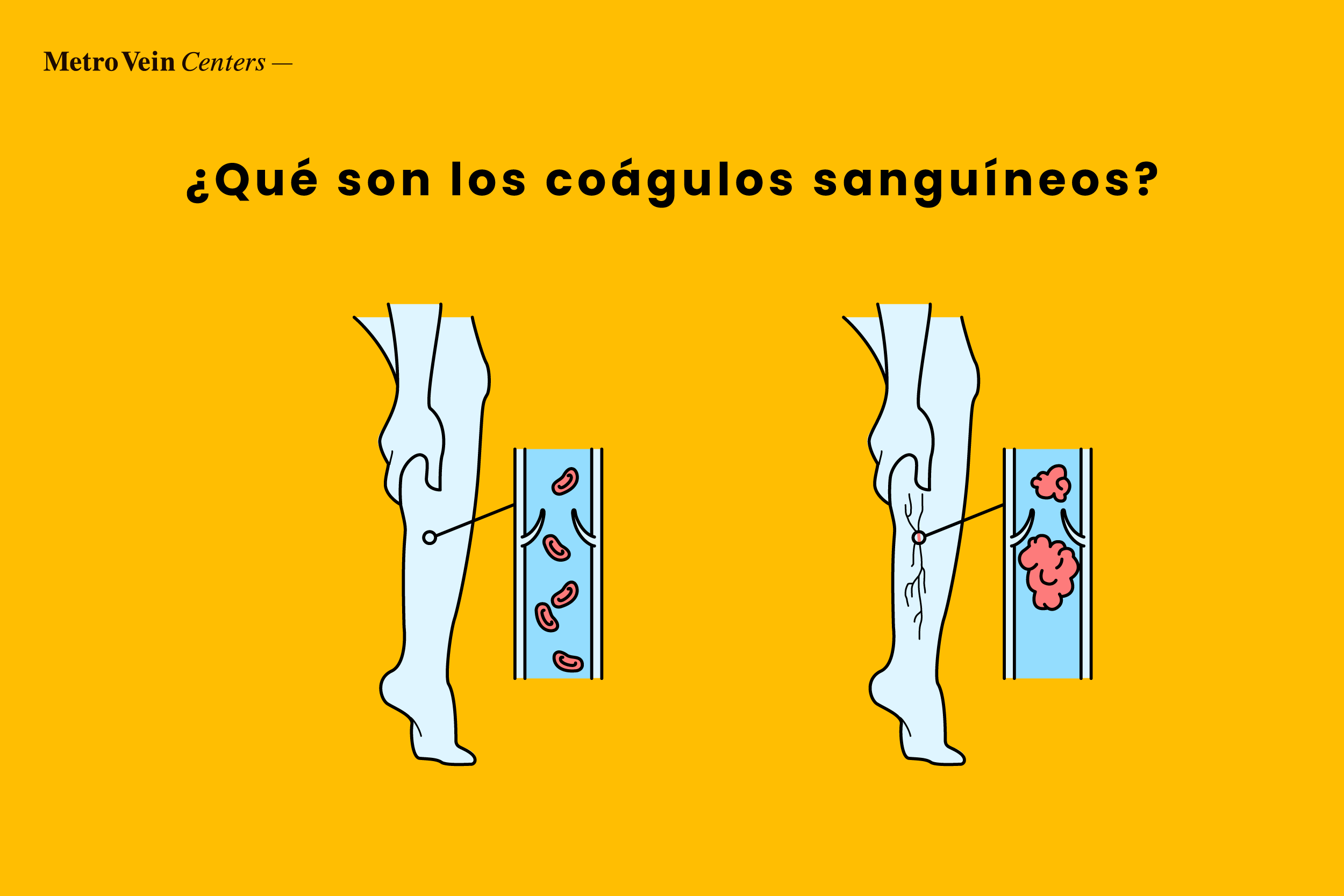 Aprende a identificar coágulos de sangre en los tobillos, pies y piernas con imágenes detalladas. Descubre los síntomas, el diagnóstico y las opciones de tratamiento para unas piernas más seguras.