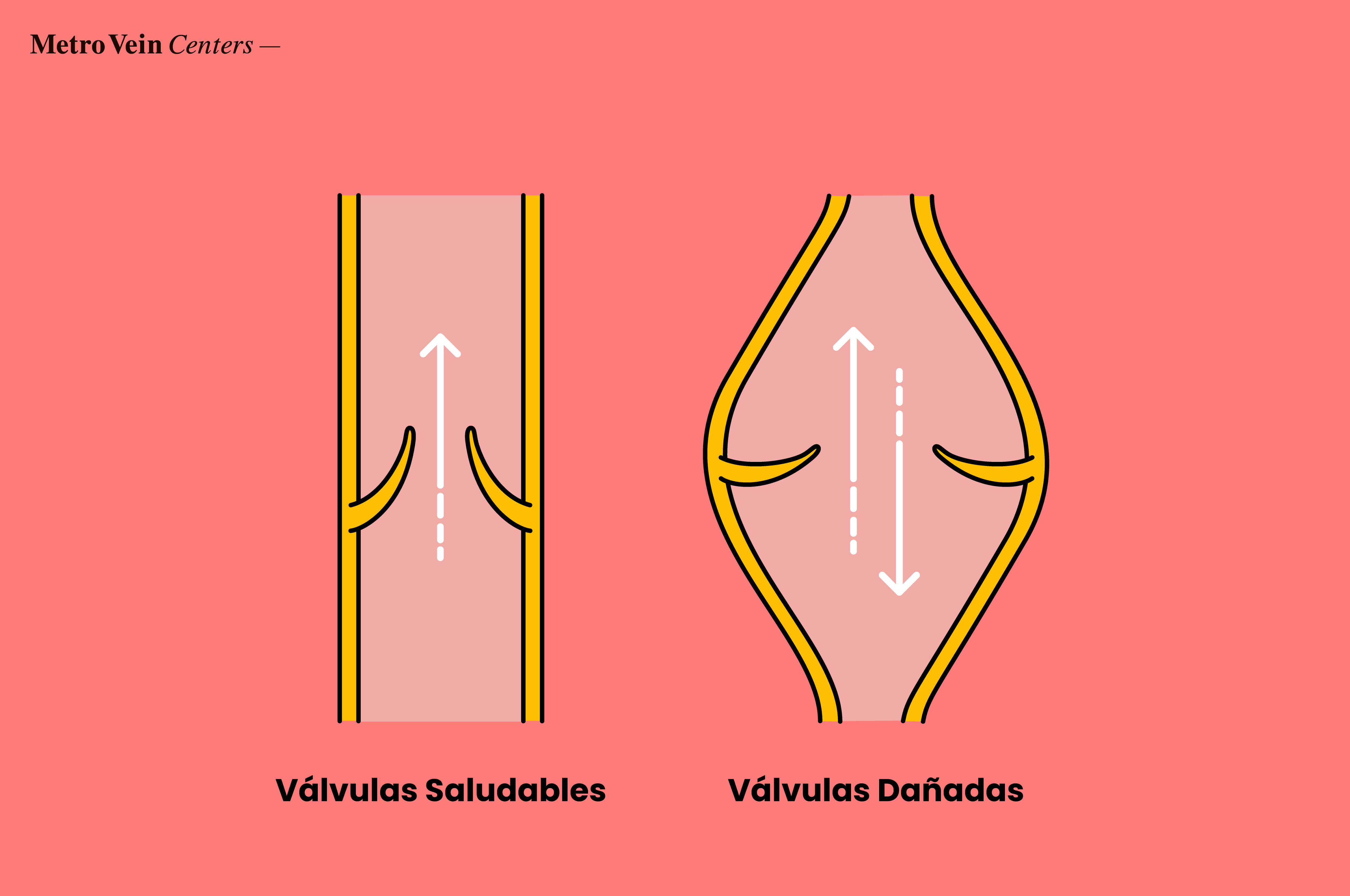 Flujo sanguíneo en venas sanas vs. venas dañadas con insuficiencia venosa