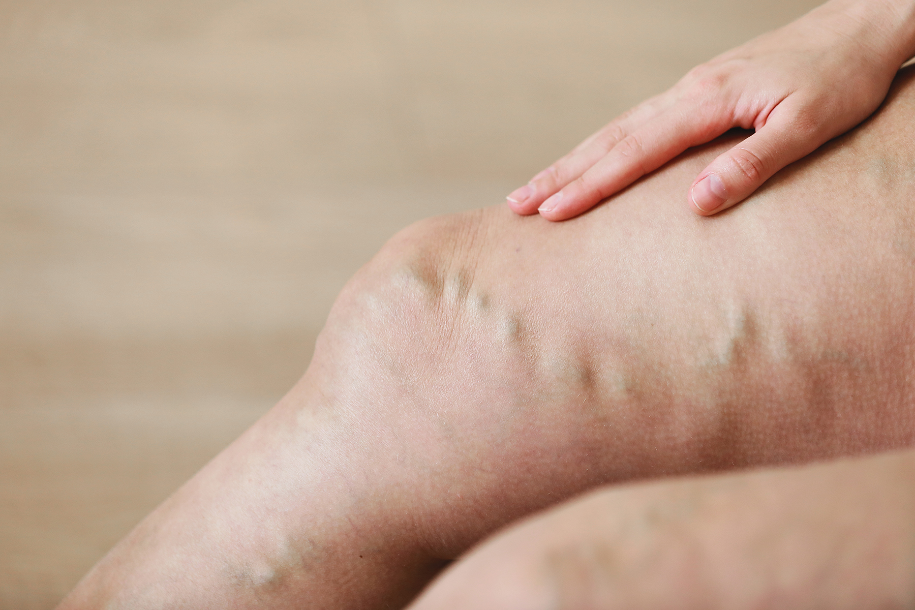 Aprende a reconocer las señales de alerta, los tratamientos y los consejos de prevención para enfermedades venosas de emergencia. ¡Actúa rápido para proteger tu salud!
