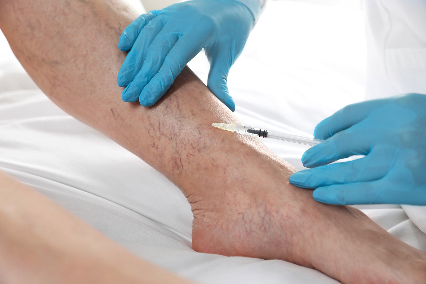 Explore las diferencias anatómicas y funcionales entre las venas del tobillo, el pie y la pierna, y aprenda cómo estas variaciones afectan la salud vascular.