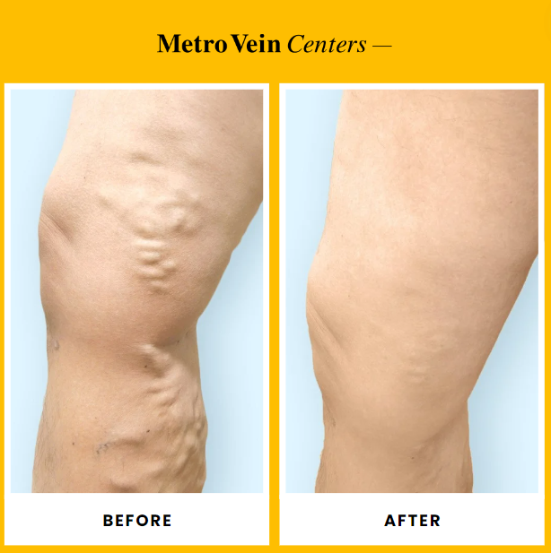 Before and After varicose vein treatment