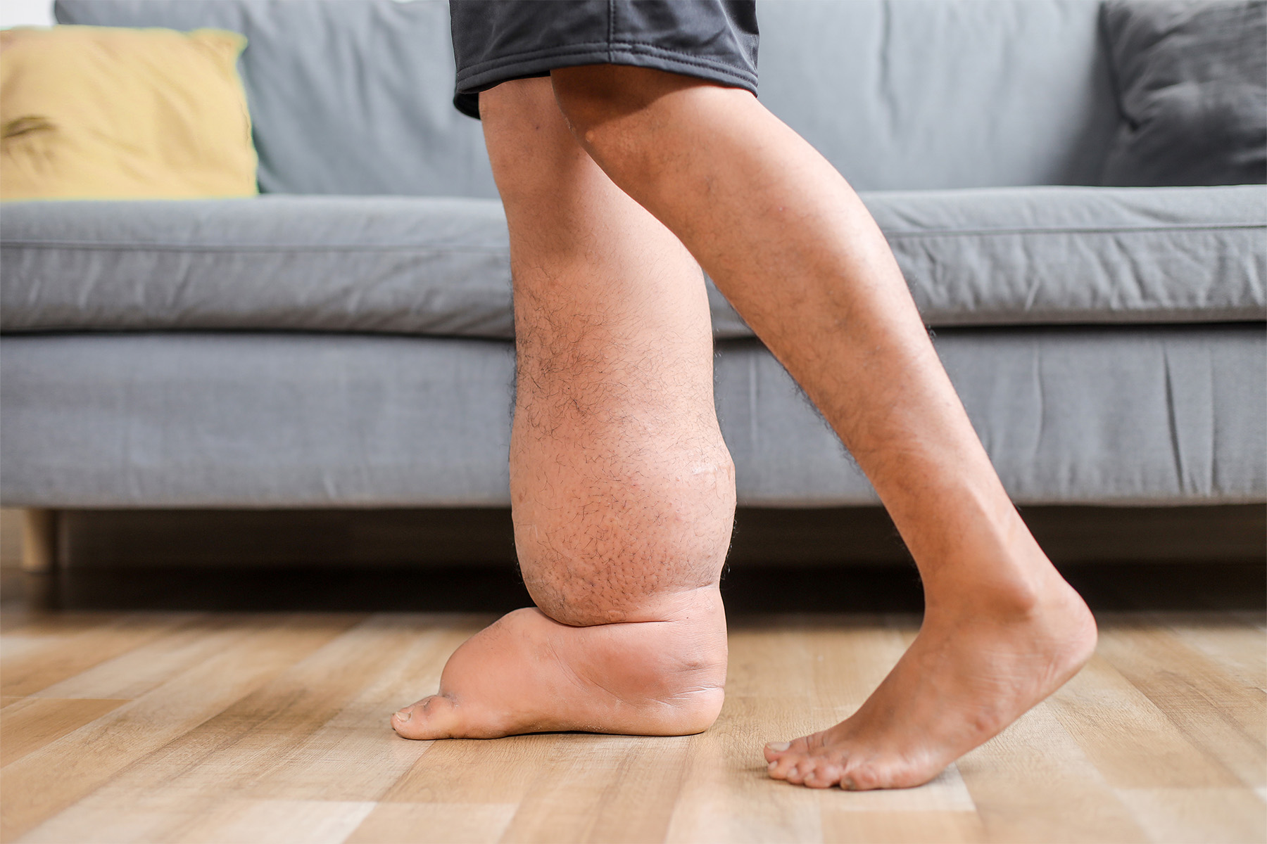 Descubra cómo se relacionan el linfedema y las varices, en qué se diferencian, qué factores de riesgo comparten y cuándo consultar a un especialista en venas.