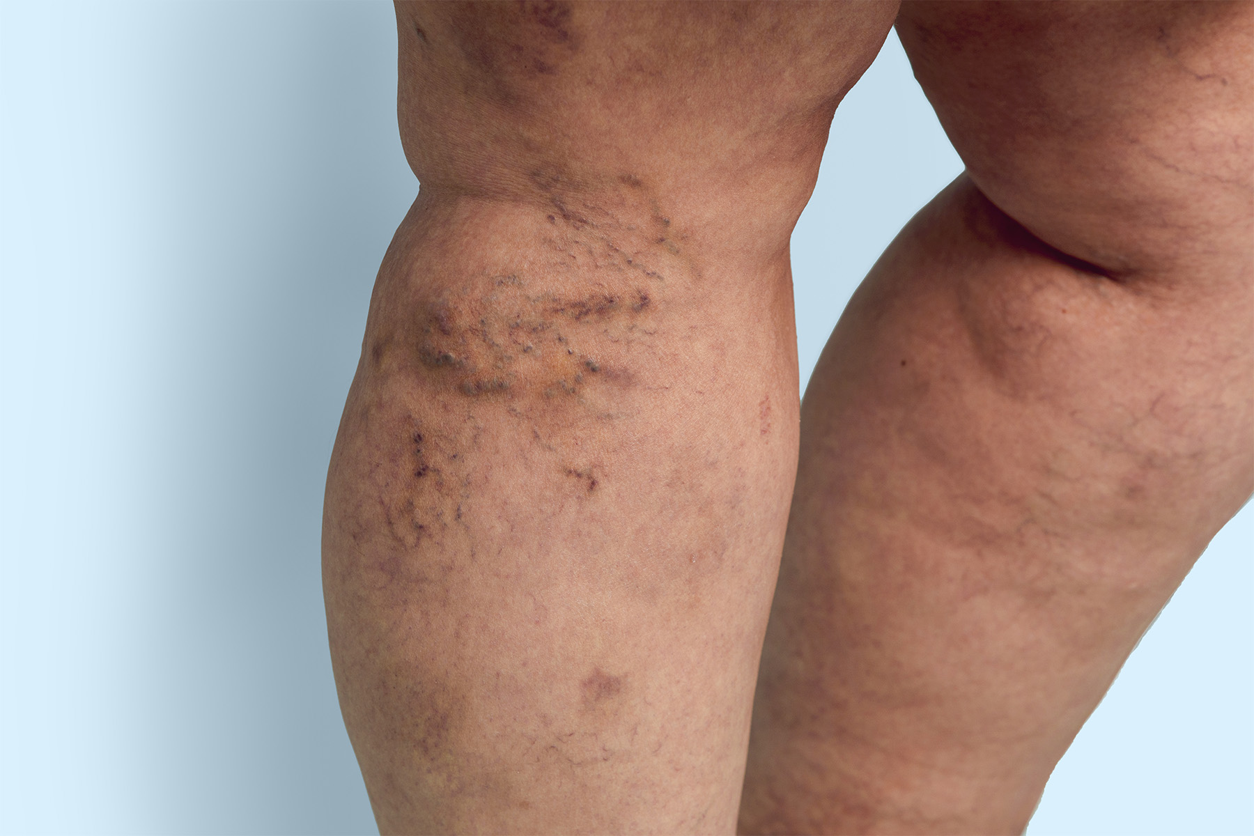Descubra consejos de expertos para cuidar las venas de las piernas, prevenir las v&aacute;rices y conocer opciones de tratamiento dise&ntilde;adas espec&iacute;ficamente para la salud vascular de la mujer.