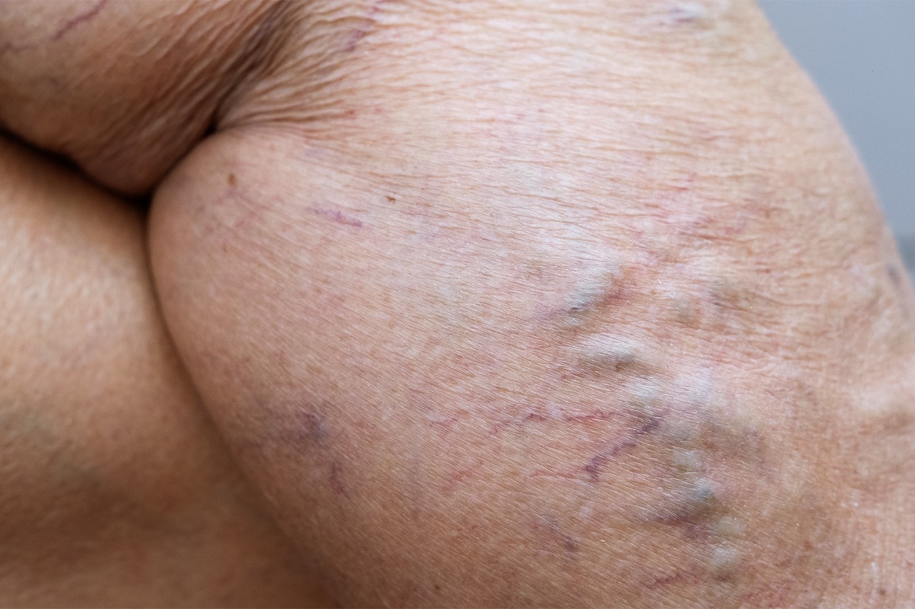 Aprende cómo la humedad afecta la salud de las venas y descubre estrategias prácticas para prevenir la hinchazón, reducir las molestias y mantener una circulación saludable en ambientes cálidos y húmedos.