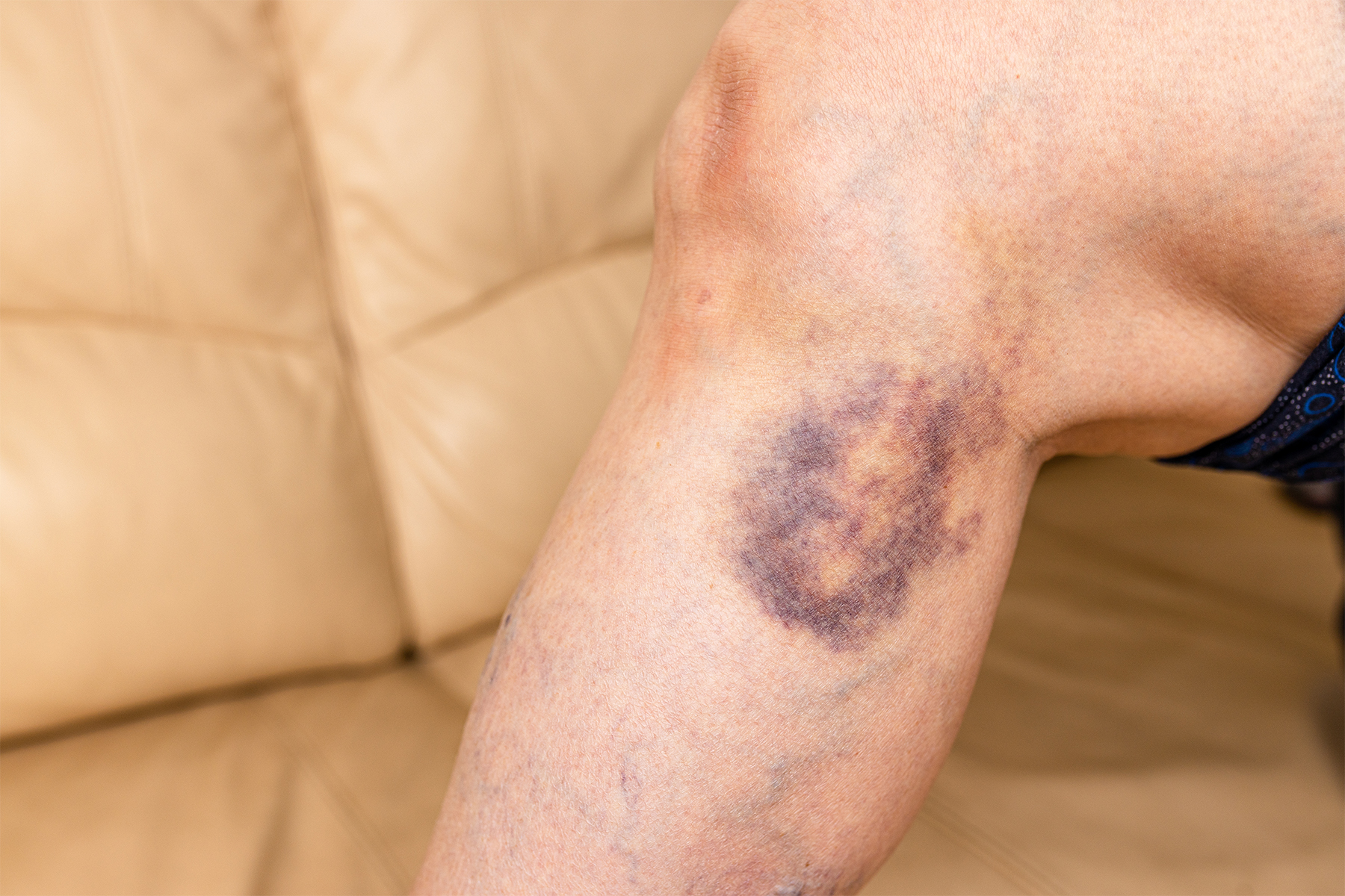 Aprenda a manejar eficazmente los efectos secundarios comunes de los tratamientos venosos. Descubra consejos de expertos para una recuperación sin contratiempos y resultados óptimos de su procedimiento venoso.