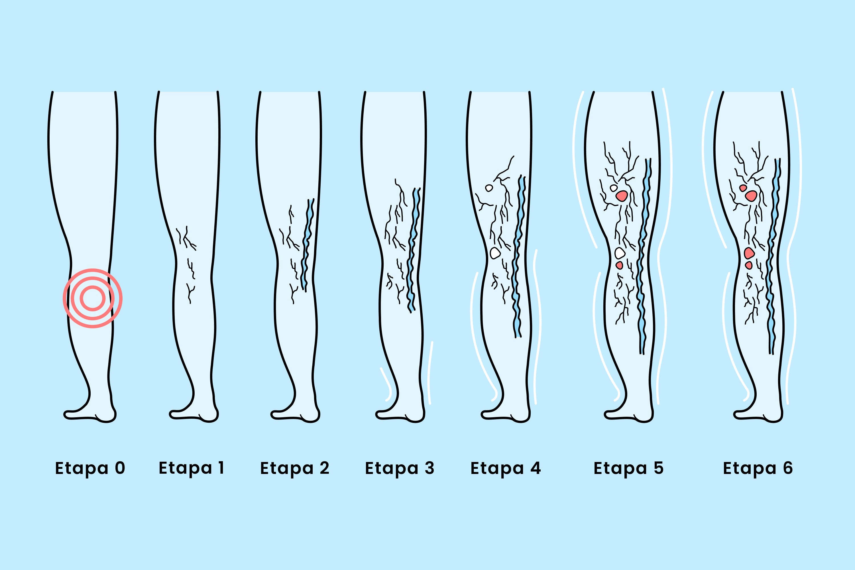 El diagnóstico de insuficiencia venosa crónica (IVC) del presidente Trump explicado: síntomas, causas y tratamientos modernos para esta común y tratable enfermedad venosa.