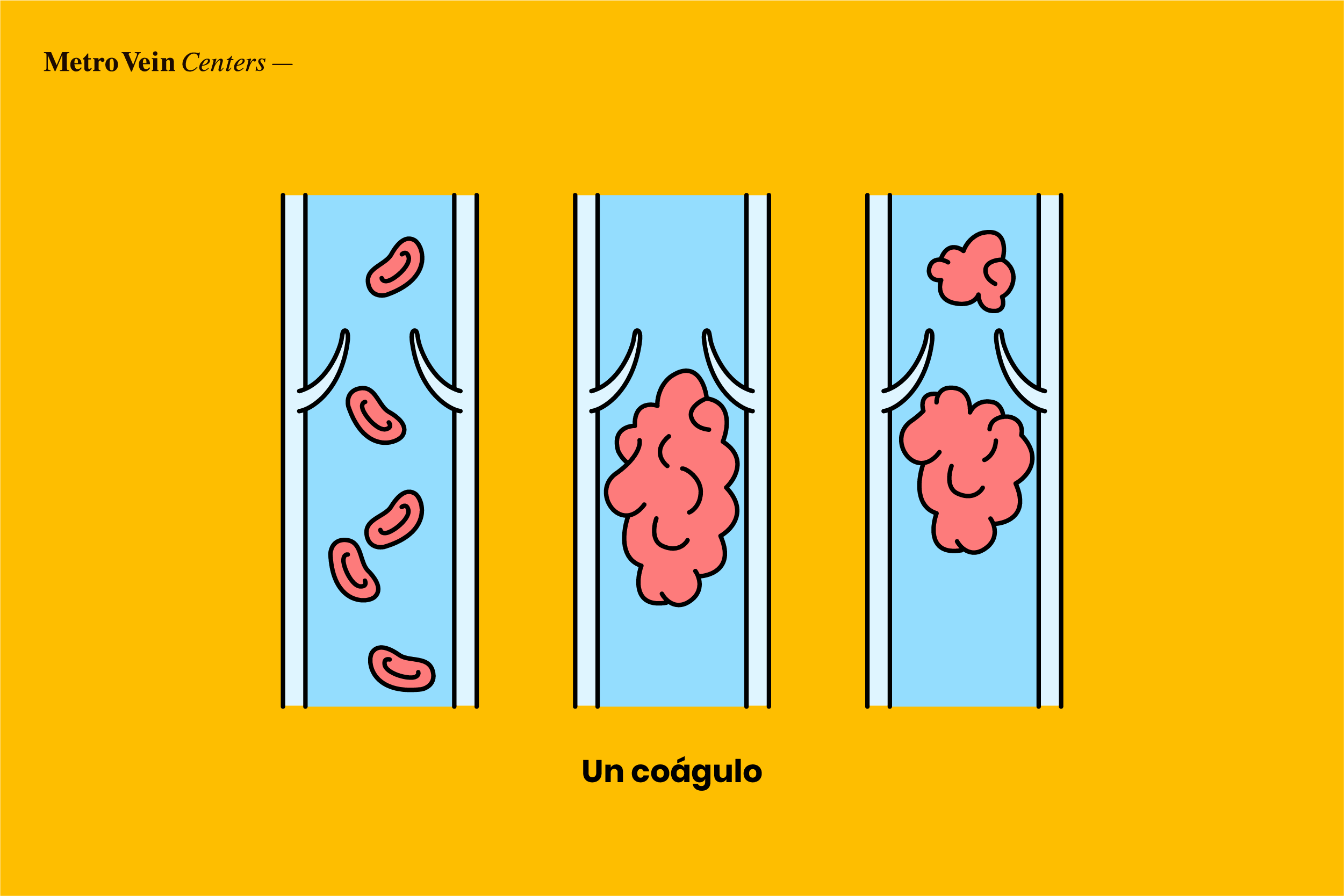 un coágulo